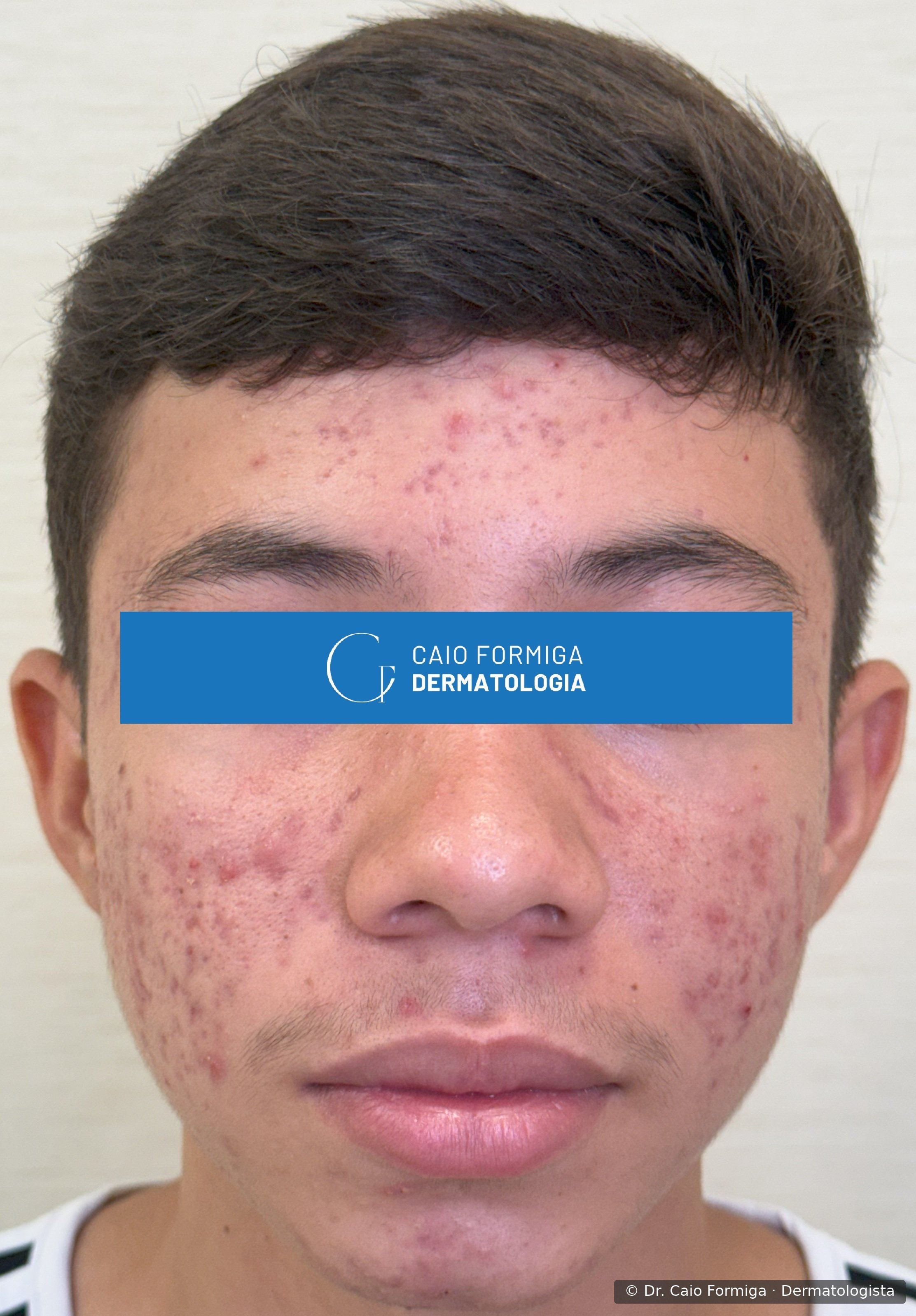 Face de paciente jovem do sexo masculino com acne inflamatória ativa: múltiplas pápulas e pústulas eritematosas em fronte, malar bilateral, perinasal e mento, antes do tratamento.