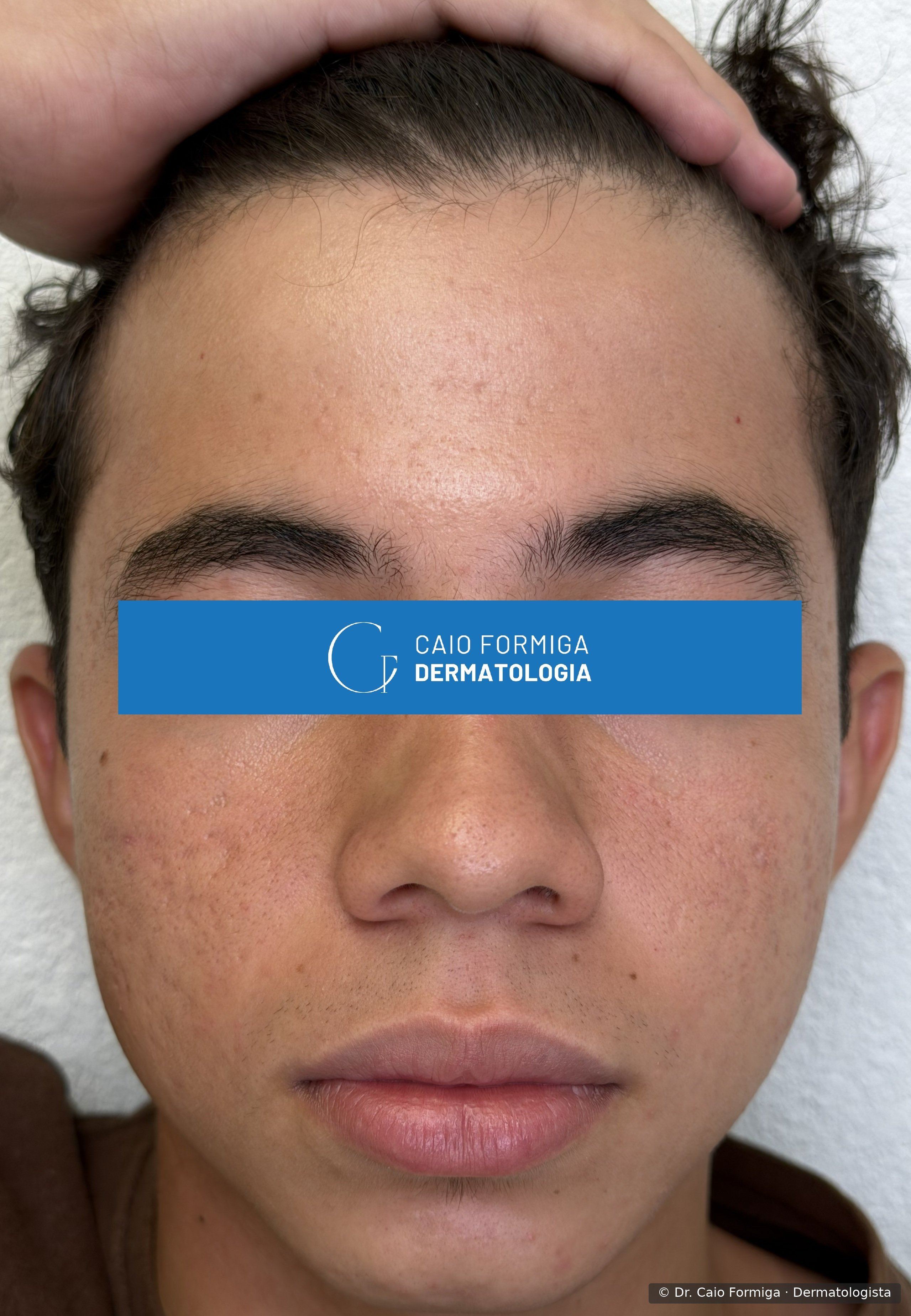 Mesmo paciente após tratamento com isotretinoína — pele uniforme, sem lesões inflamatórias ativas, com discreta hiperpigmentação pós-inflamatória residual.