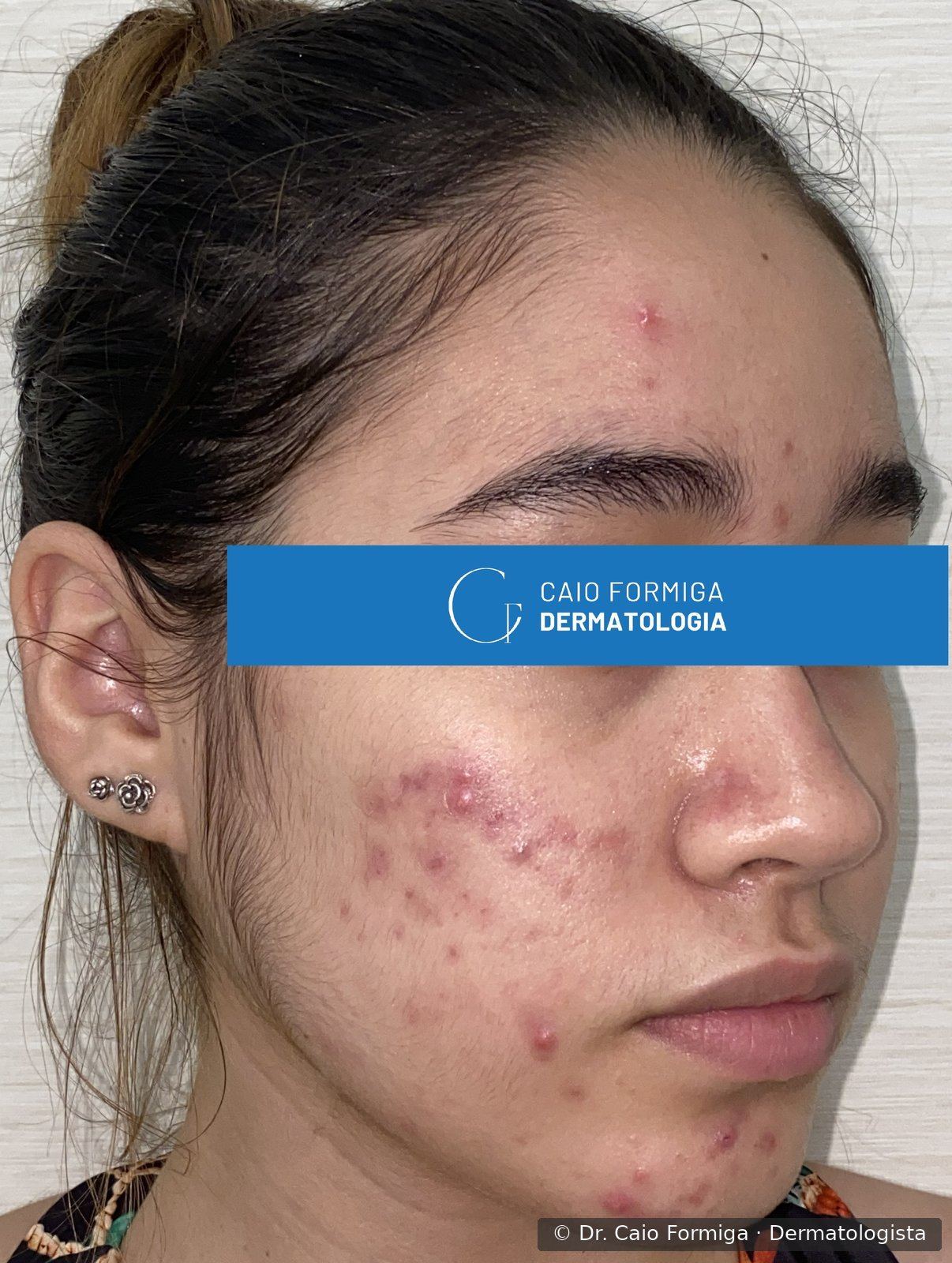 Acne hormonal com lesões inflamatórias na região do queixo e mandíbula antes do tratamento com isotretinoína.