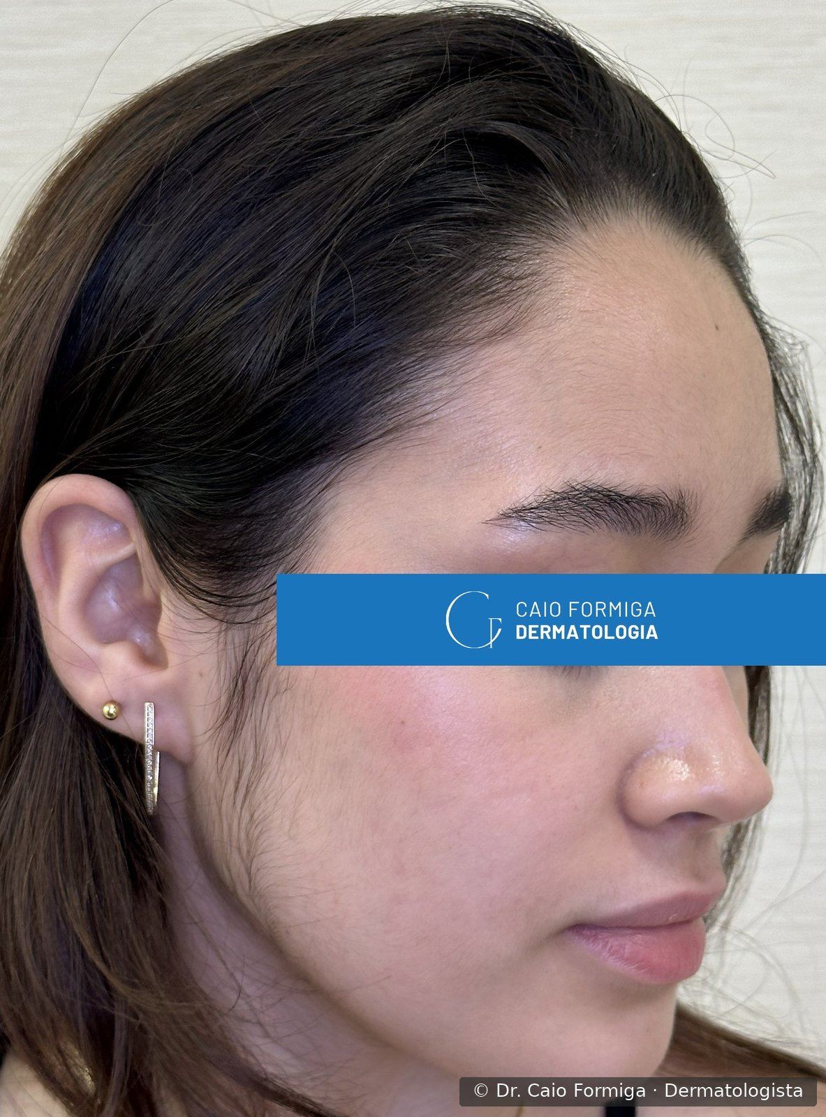 Pele com inflamação significativamente reduzida após tratamento com isotretinoína em paciente com acne hormonal.