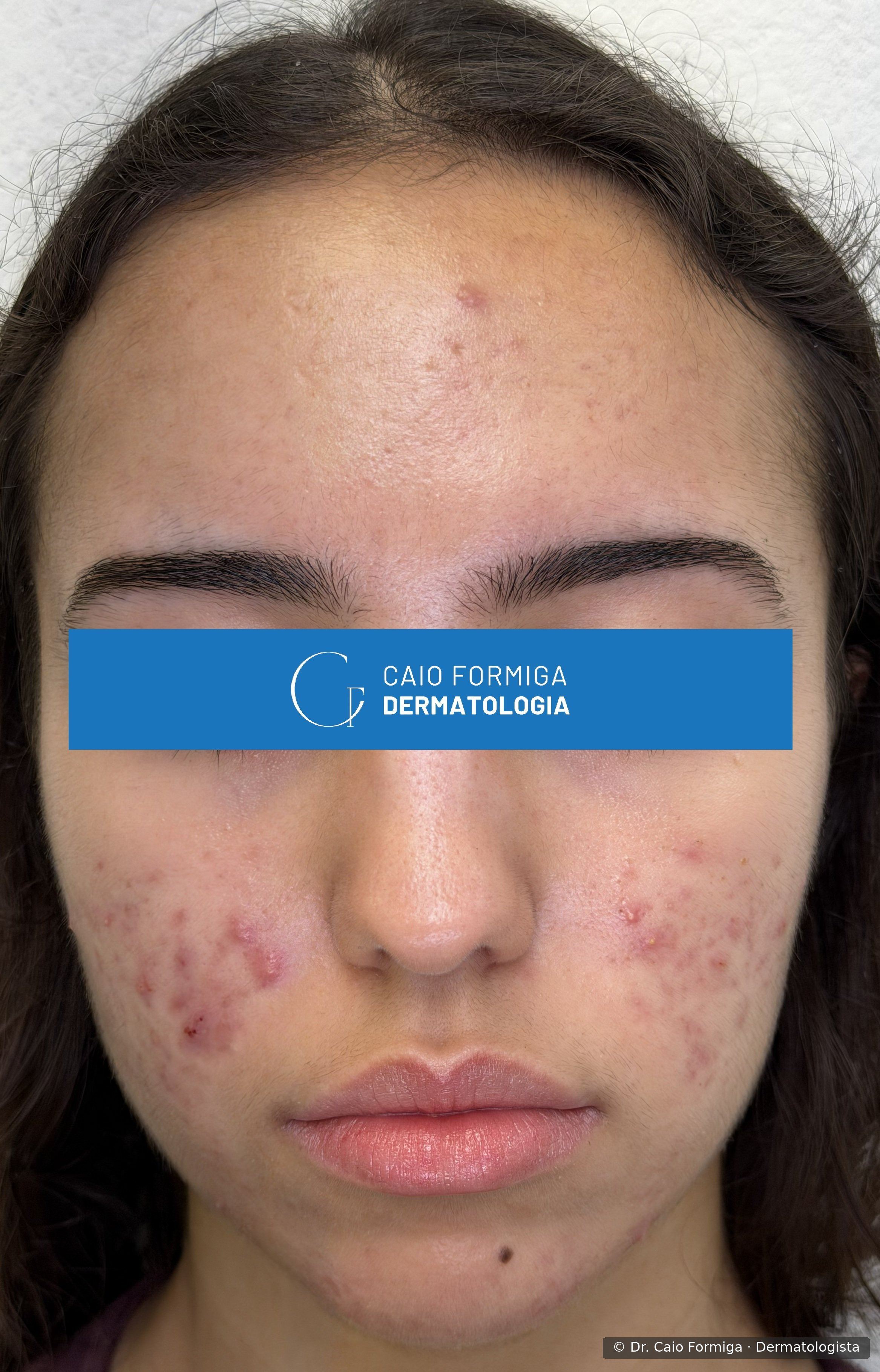 Face de paciente jovem com acne inflamatória ativa: múltiplas pápulas e pústulas eritematosas em região malar bilateral e fronte, com eritema marcado, antes do tratamento.