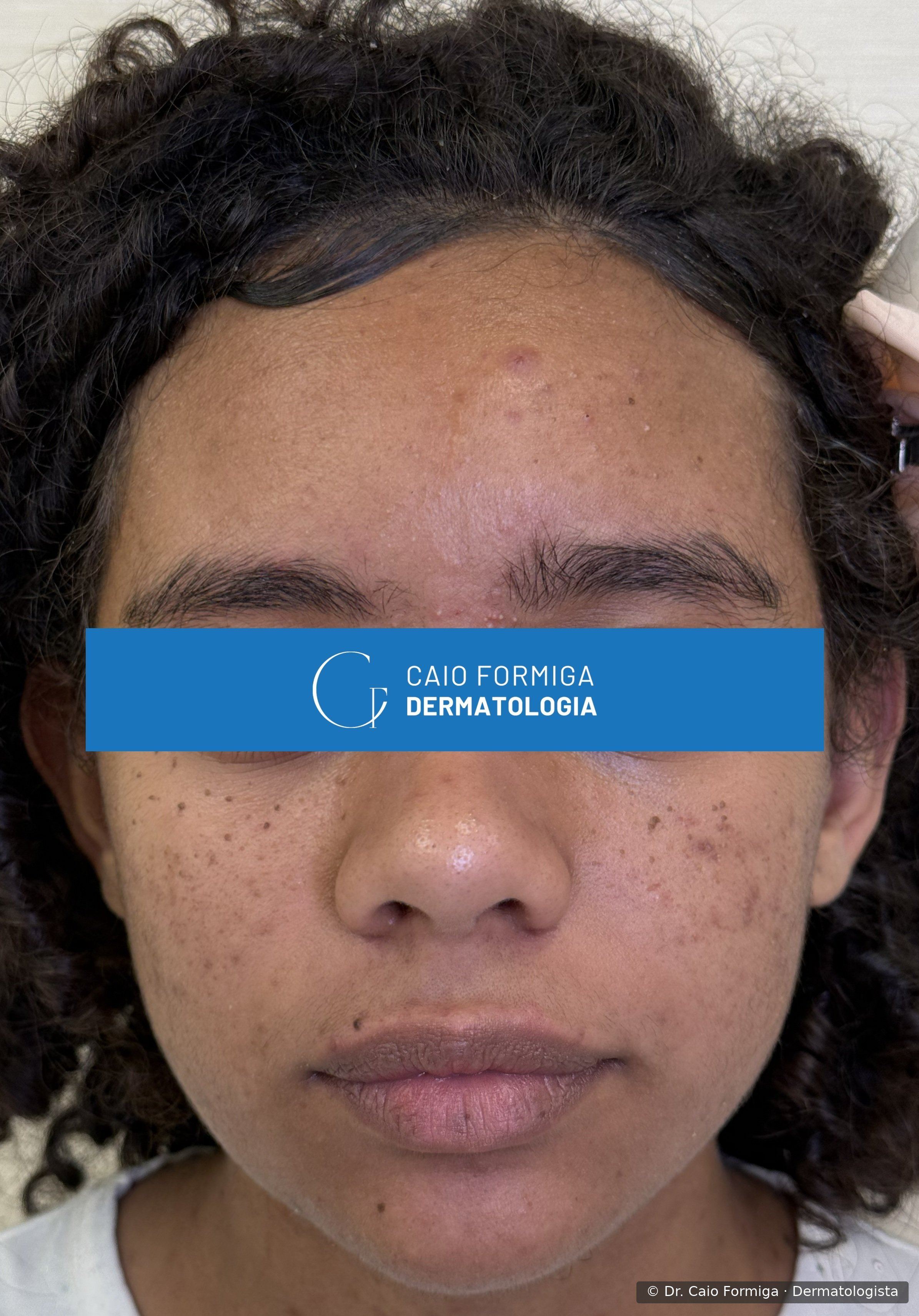 Face de paciente com hiperpigmentação pós-inflamatória extensa por acne, com múltiplas máculas acastanhadas dispersas em fronte, malar, perinasal e mento, antes do tratamento.