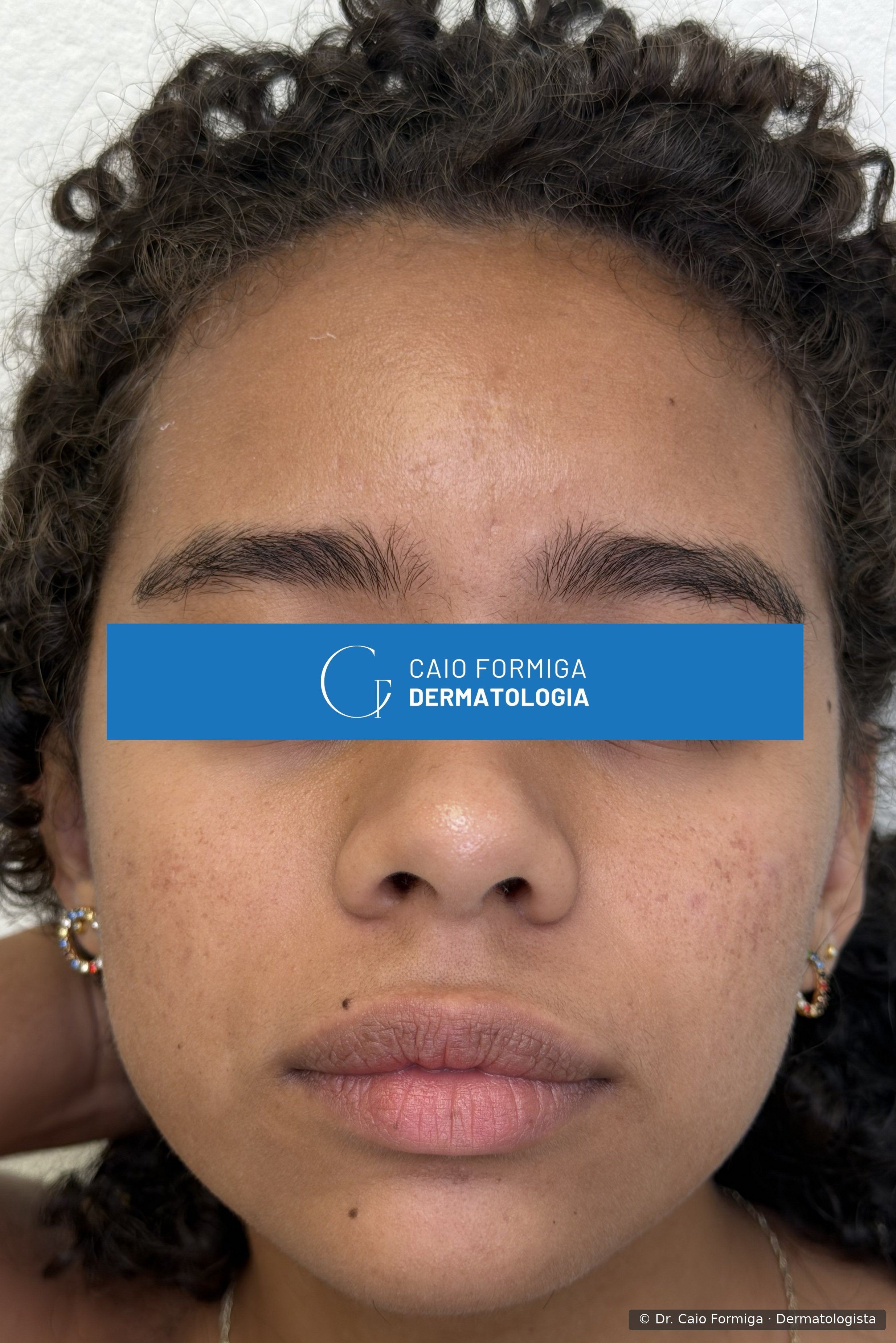 Mesma paciente após tratamento com isotretinoína, RedTouch, SmartPico e curetagem de ceratoses — pele uniforme, com clareamento marcante das manchas e melhora da textura.