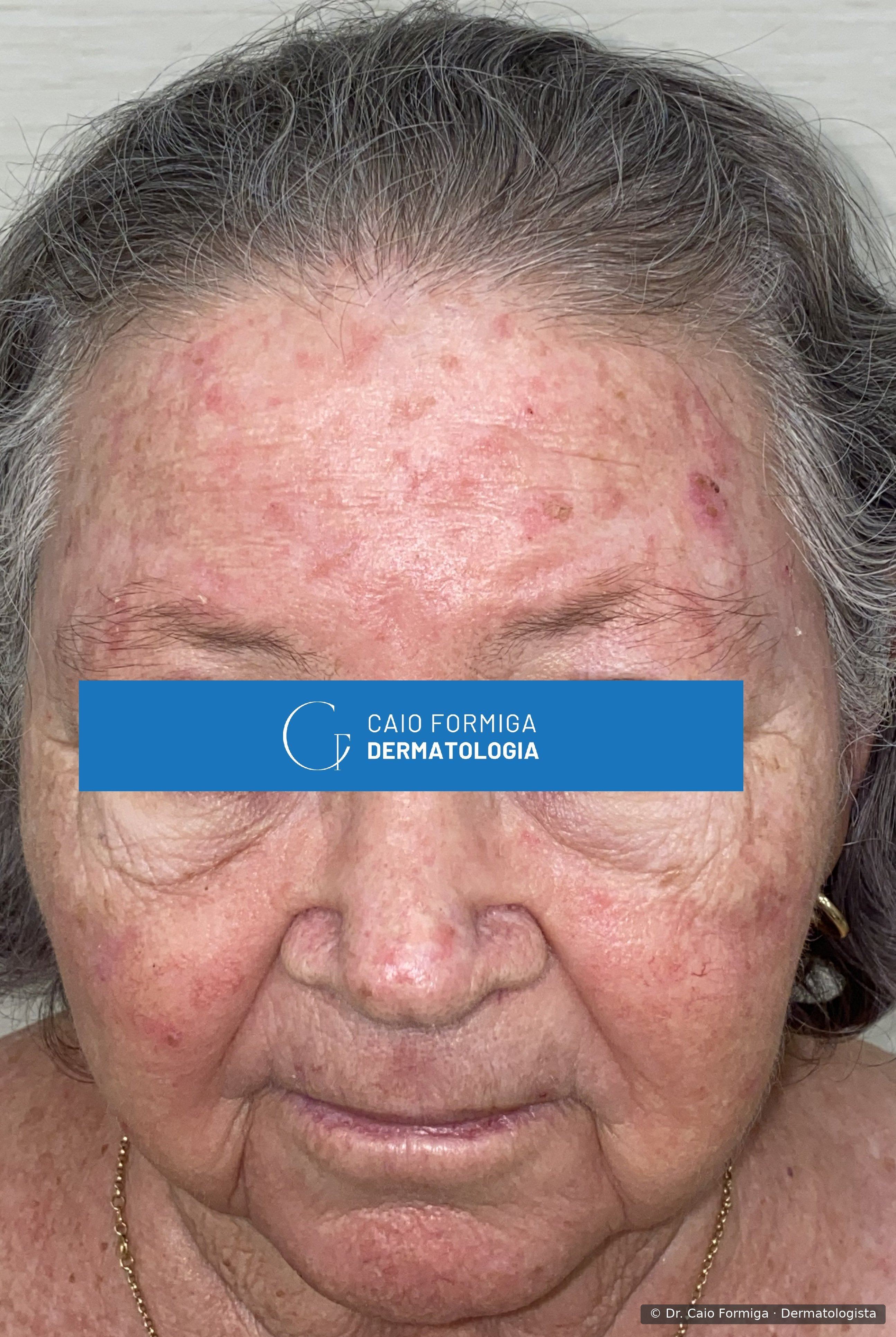 Múltiplas máculas e pápulas eritematodescamativas distribuídas pela fronte, têmporas e malar de paciente idosa, configurando ceratoses actínicas e campo de cancerização extenso por dano solar crônico.