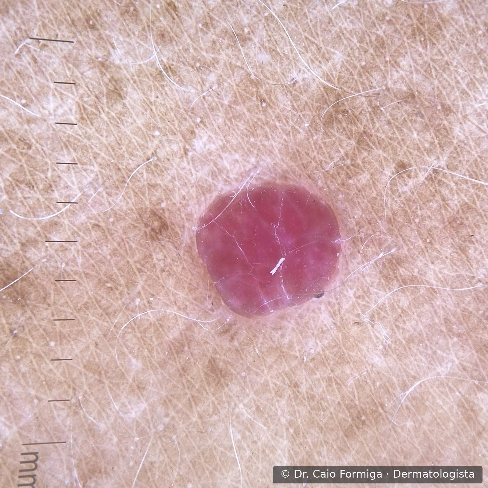 Imagem dermatoscópica de angioma rubi: lacunas vermelho-vivo bem delimitadas com septos esbranquiçados, padrão característico das lesões vasculares benignas.