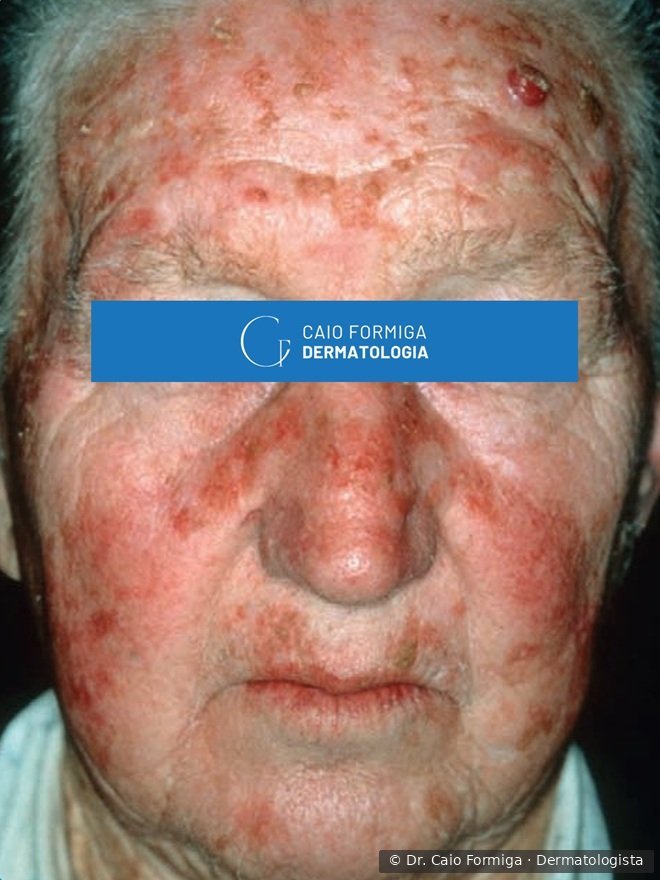 Face de paciente idoso com campo de cancerização: múltiplas ceratoses actínicas eritematodescamativas em fronte, têmporas, malar e dorso nasal, e nódulo eritematoso ulcerado na testa, sugestivo de carcinoma espinocelular invasivo.