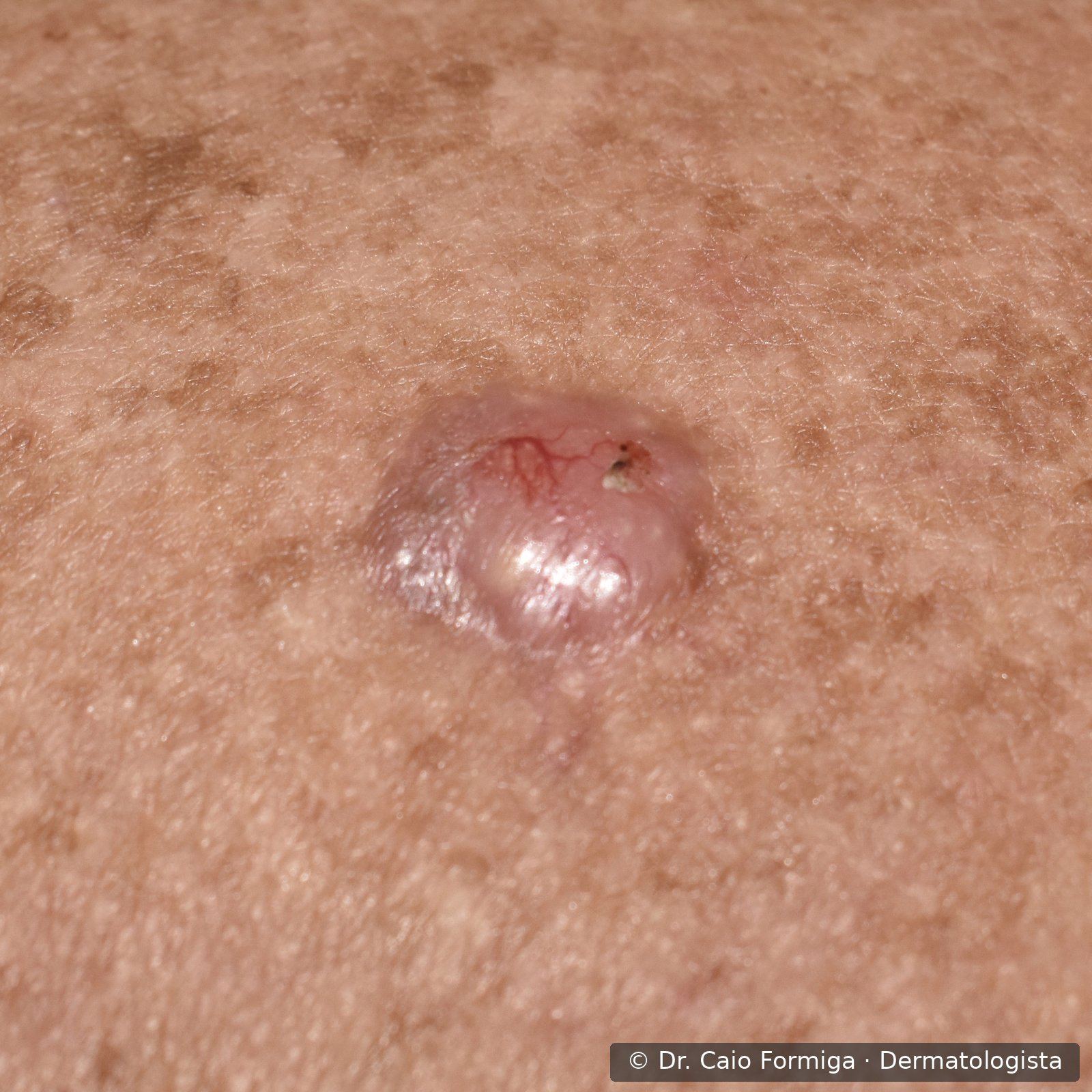 Pápula perlácea com telangiectasias arboriformes na superfície e bordas elevadas, característica de carcinoma basocelular nodular.