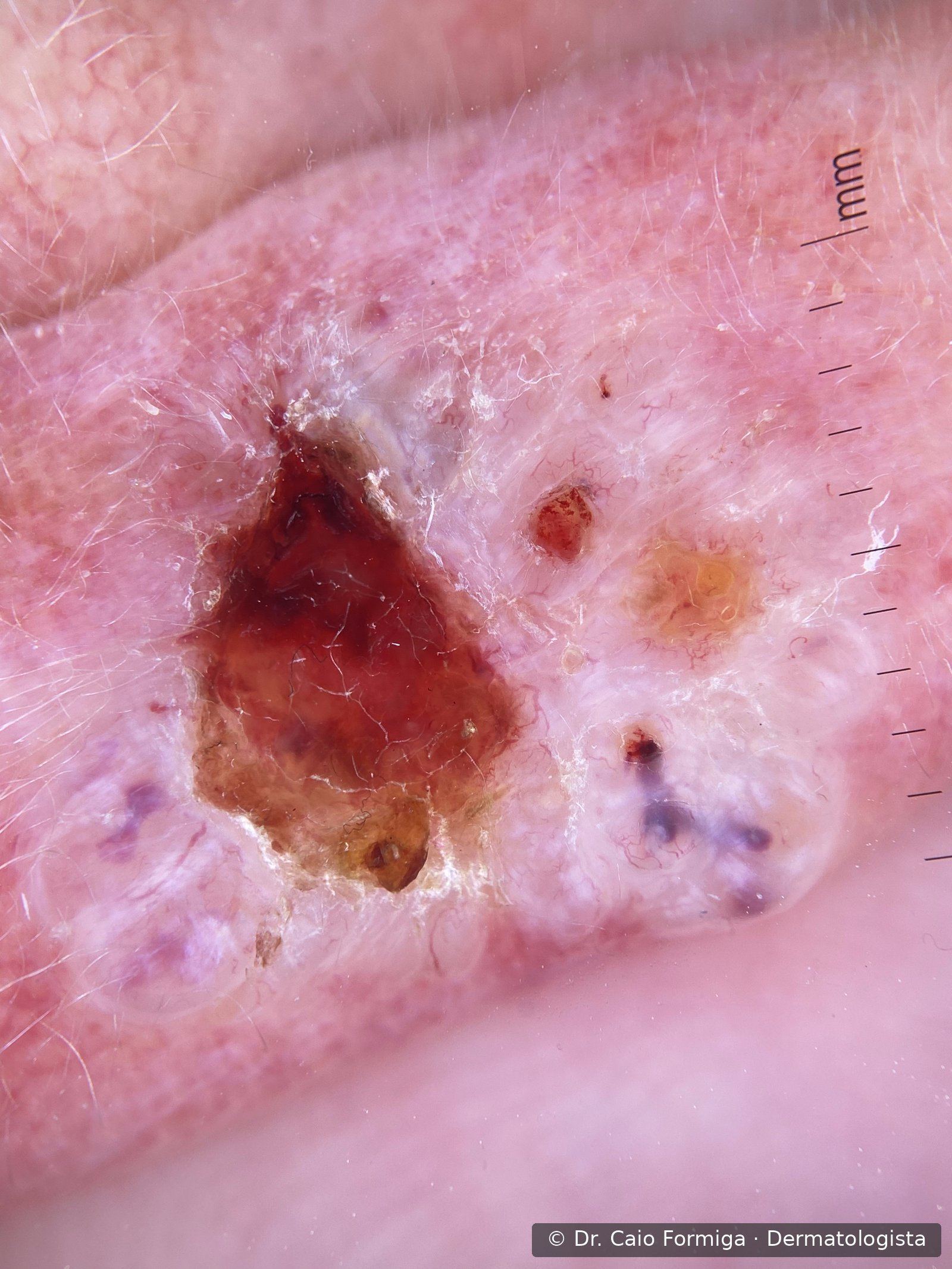 Nódulo perlado eritematoso de superfície brilhante com telangiectasias visíveis, compatível com carcinoma basocelular.