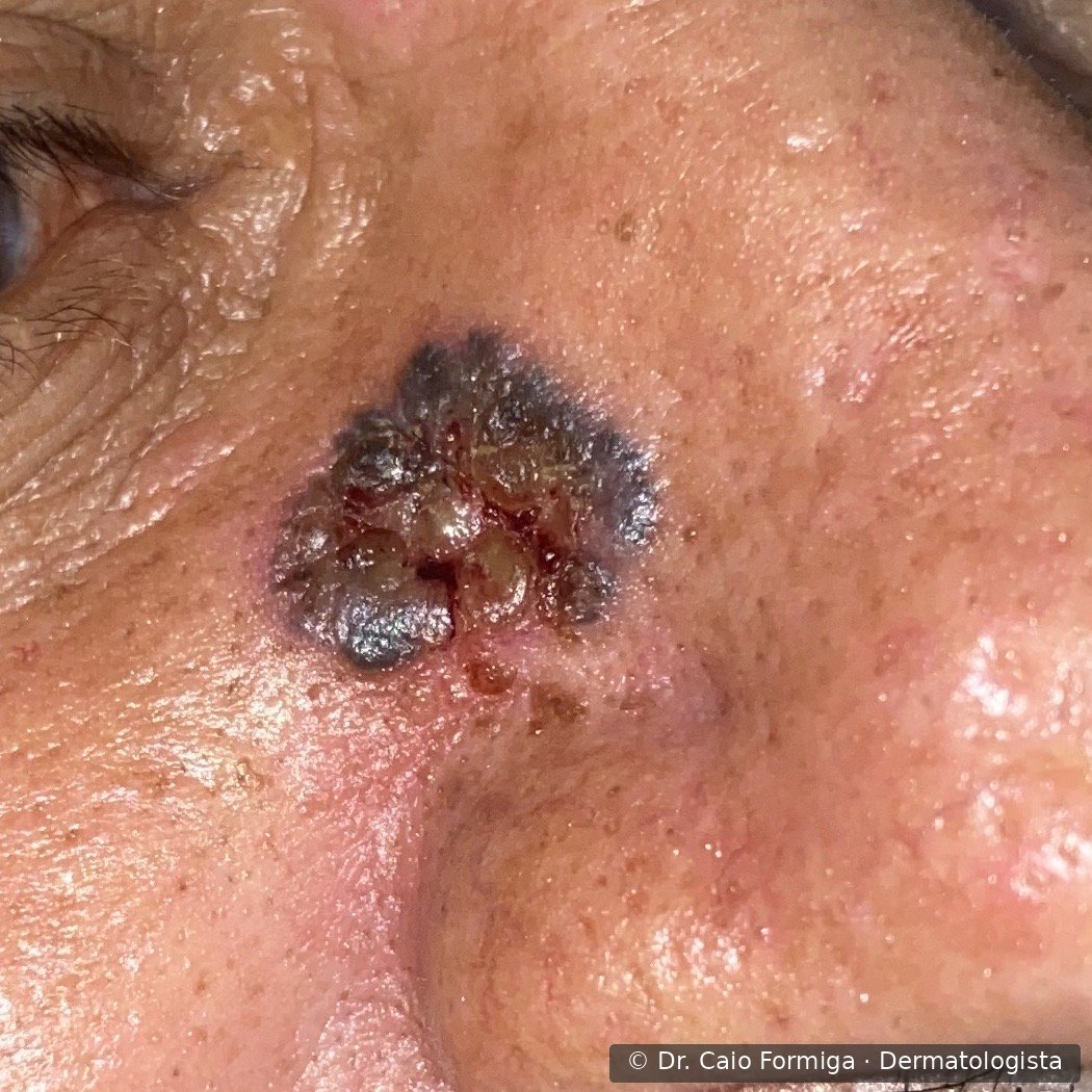 Lesão papulosa com áreas pigmentadas em pele fotoexposta, variante pigmentada do carcinoma basocelular.