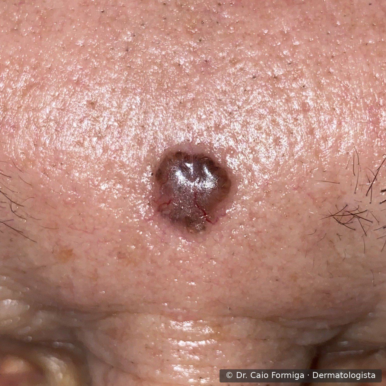 Carcinoma basocelular com ulceração central e bordas elevadas perladas, padrão típico das lesões mais avançadas.