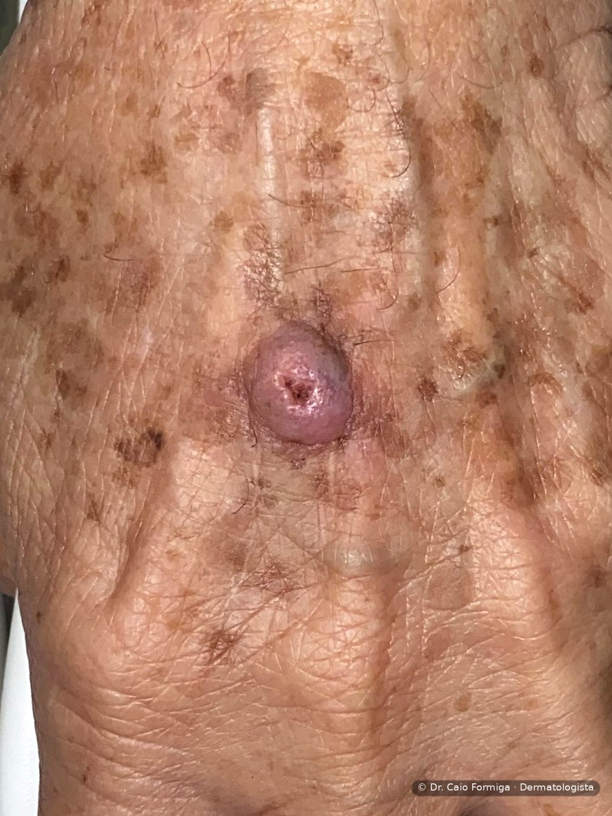 Nódulo eritemato-violáceo de superfície ceratósica e ulceração central no dorso da mão de paciente idoso, sobre pele com lentigos solares e fotodano crônico, compatível com carcinoma espinocelular invasivo.