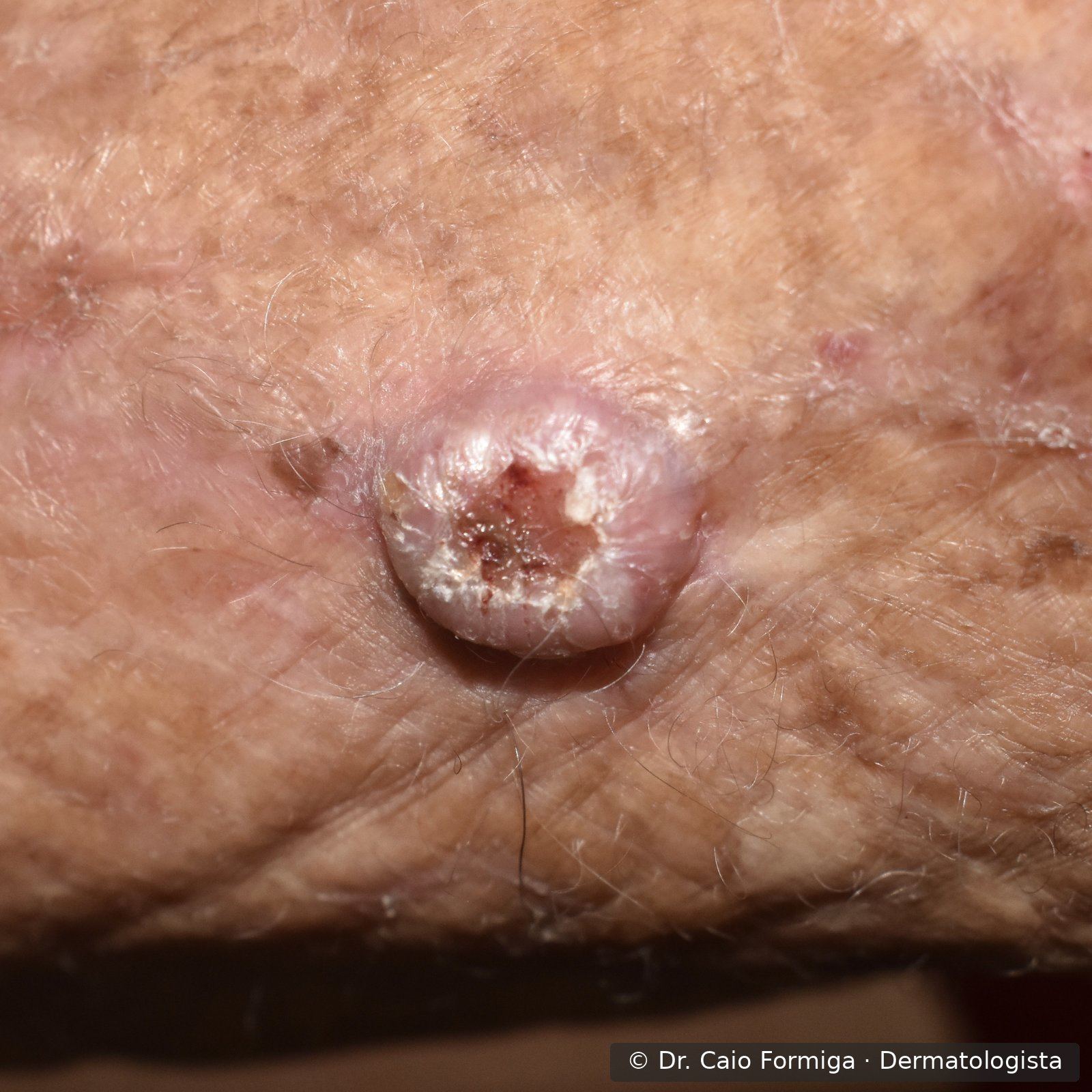 Nódulo eritematoso de superfície ceratósica com áreas erosadas em pele fotolesada, sugestivo de carcinoma espinocelular invasivo.