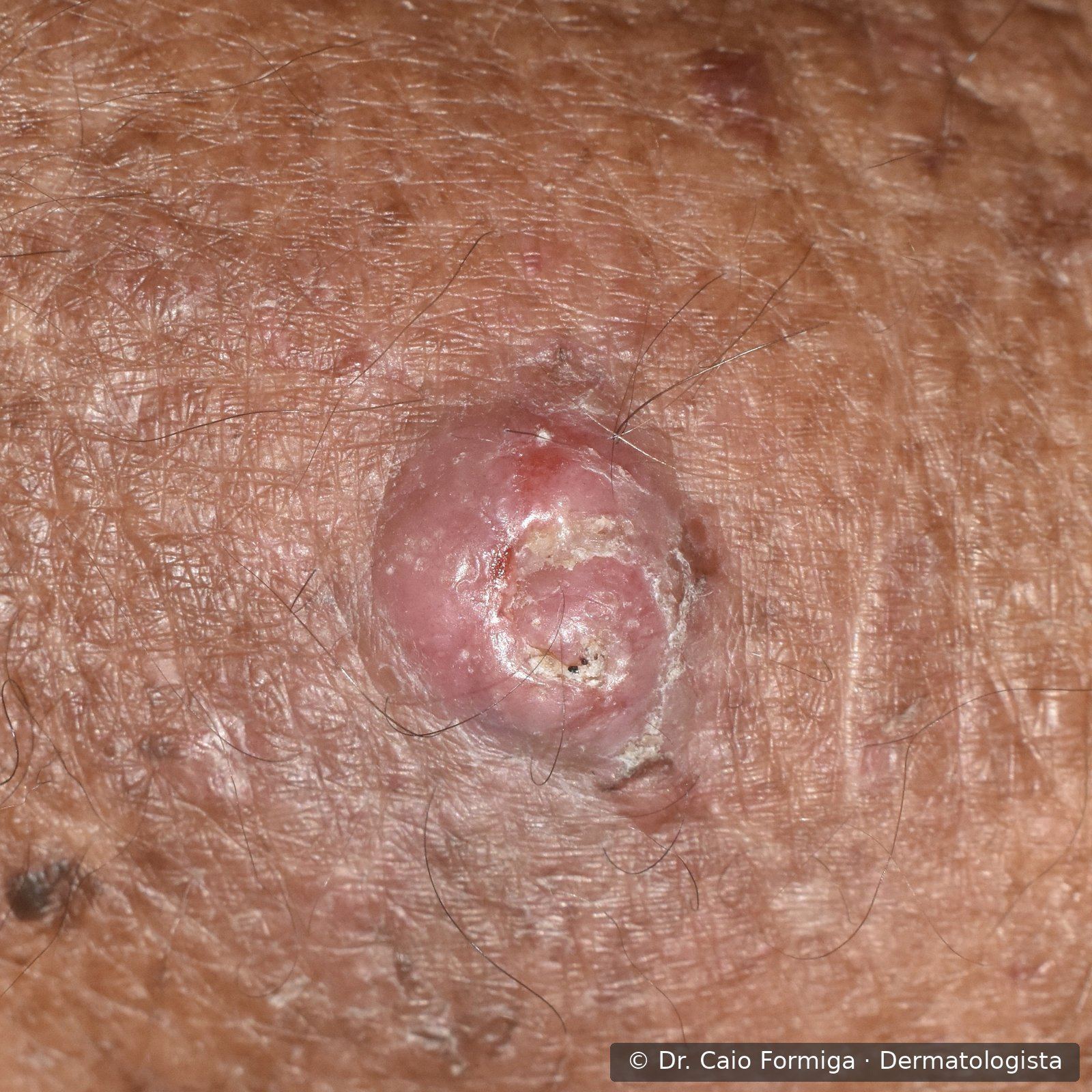 Carcinoma espinocelular com componente nodular e ulcerado em região fotoexposta, indicando lesão de maior espessura.