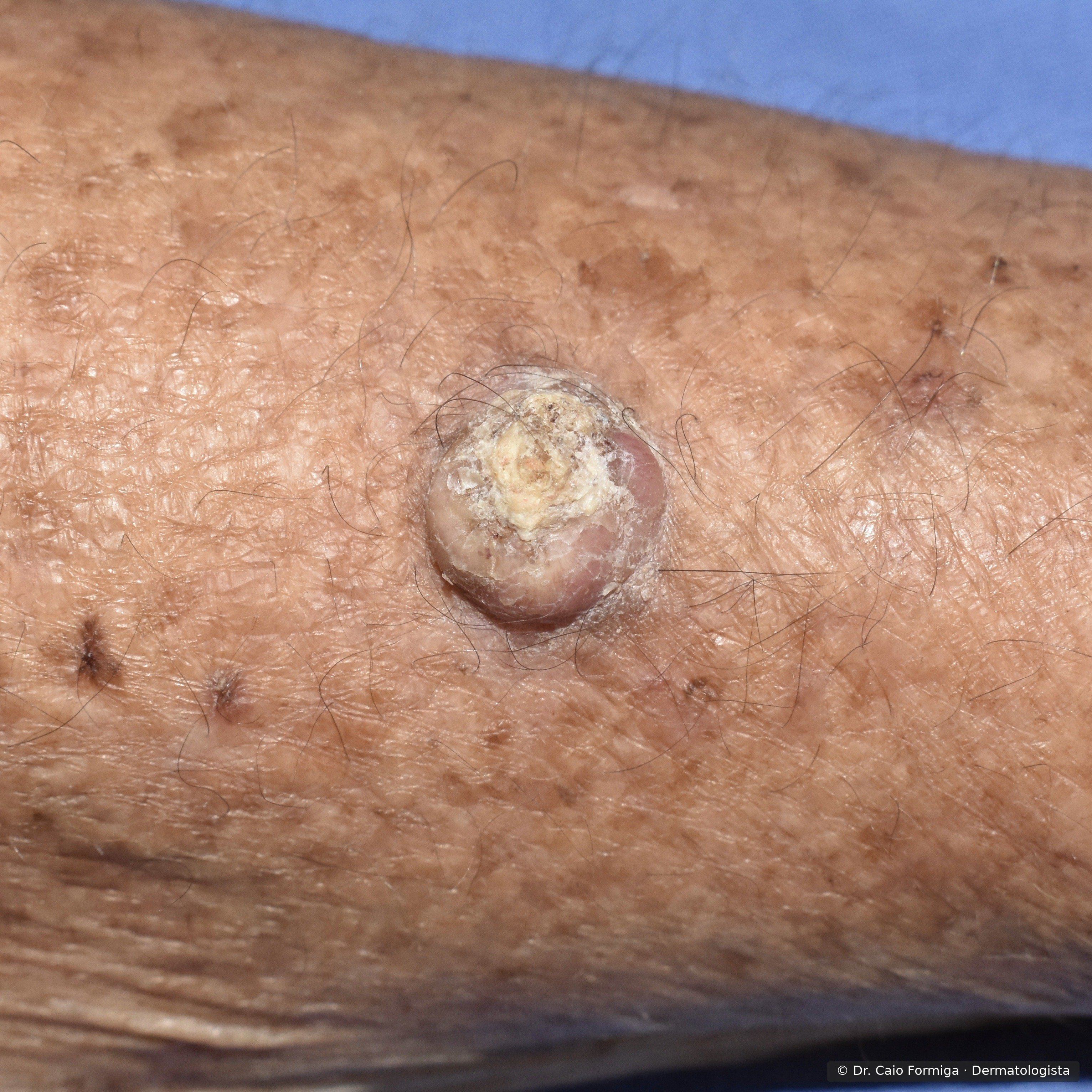 Carcinoma espinocelular em membro: nódulo arredondado com tampão ceratósico amarelado central, sobre pele com múltiplos lentigos solares e dano actínico crônico.