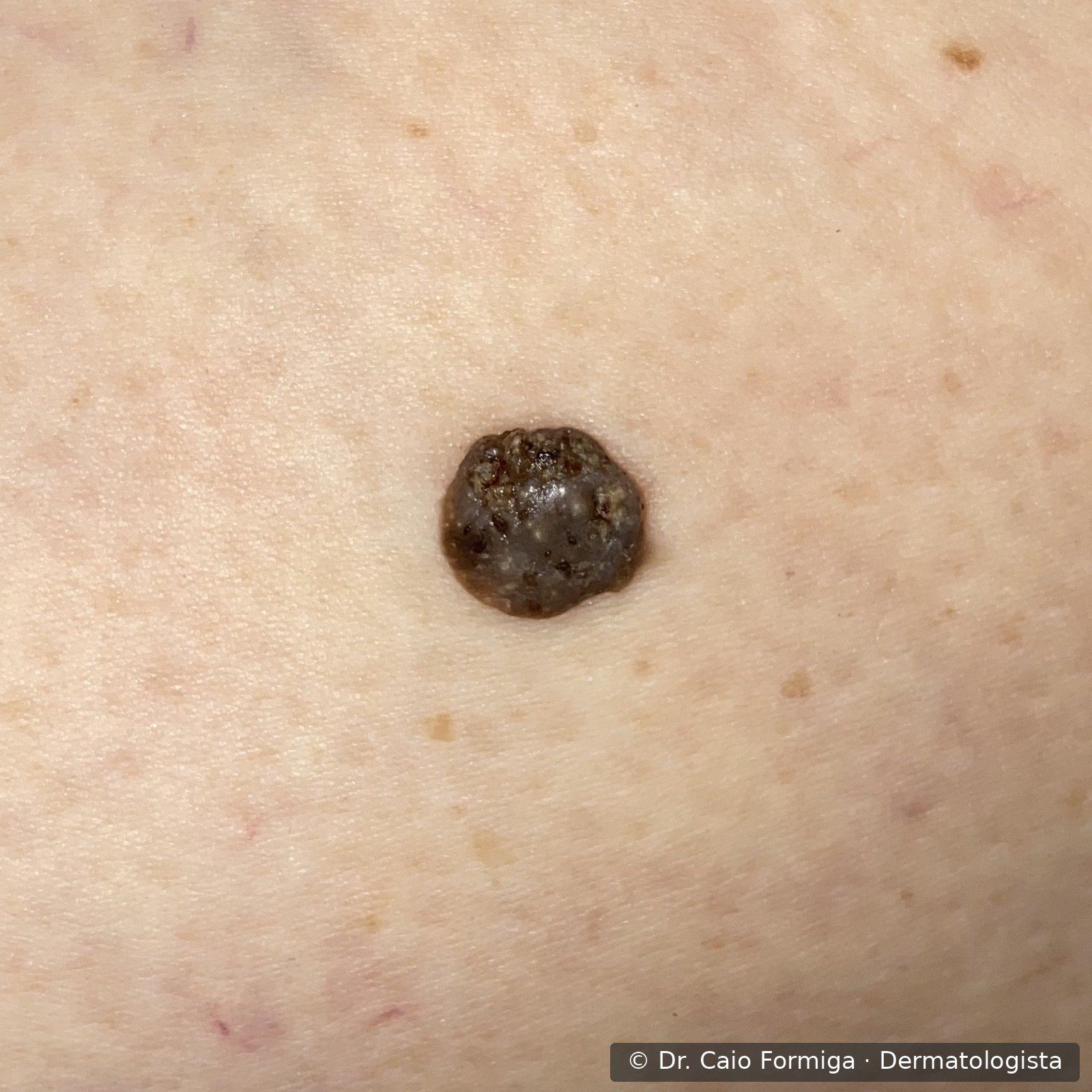 Ceratose seborreica pigmentada de superfície verrucosa e bordas bem delimitadas.