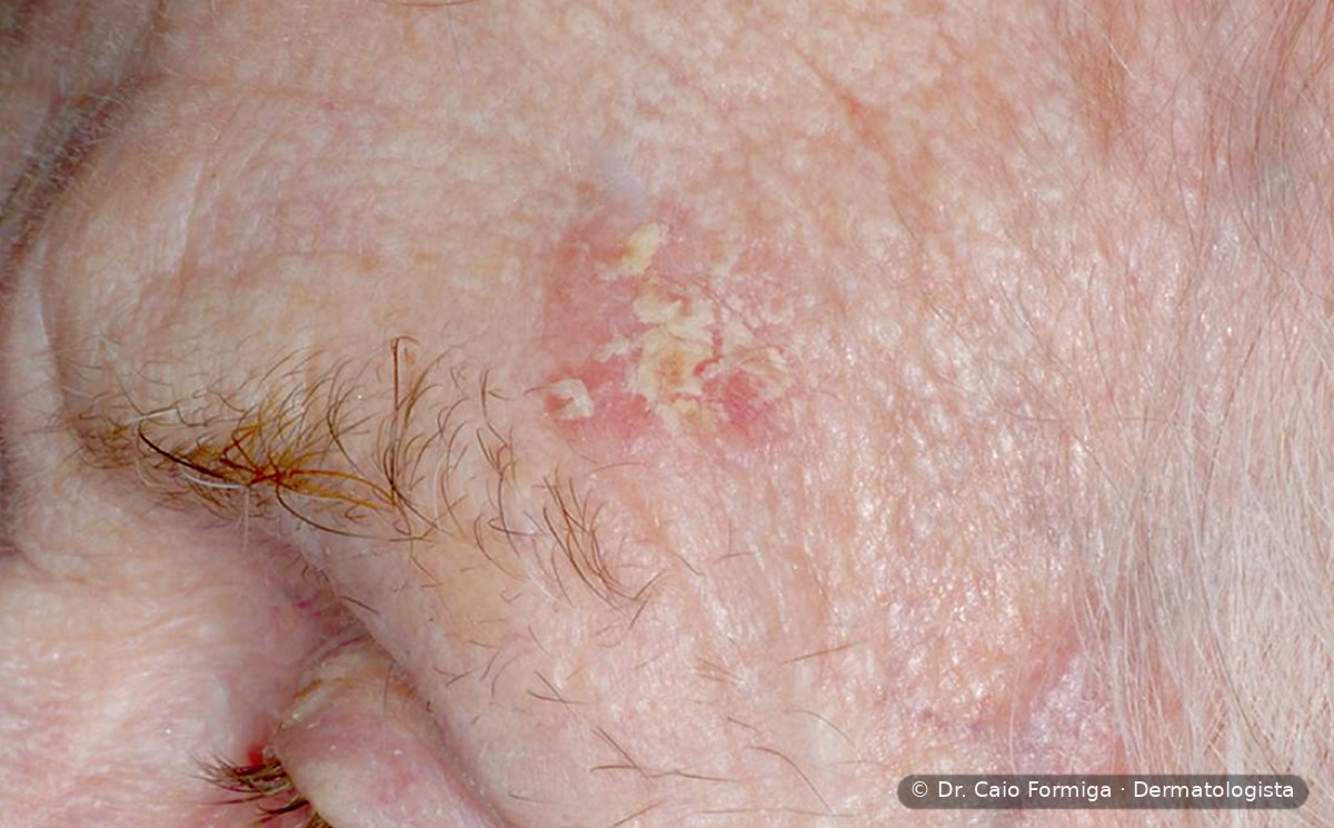 Áreas descamativas ásperas e eritematosas sobre pele fotolesada na região frontal, compatíveis com ceratose actínica.