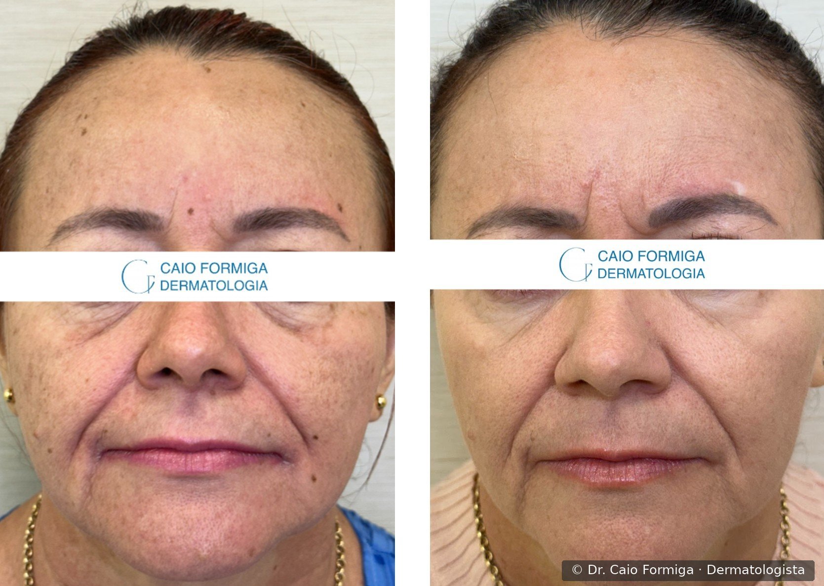 Comparação antes e depois em paciente do sexo feminino com fotodano facial: lentigos solares e manchas eritemato-acastanhadas dispersas pela face, com clareamento e uniformização significativa após três sessões de laser CO₂ focal e difuso.