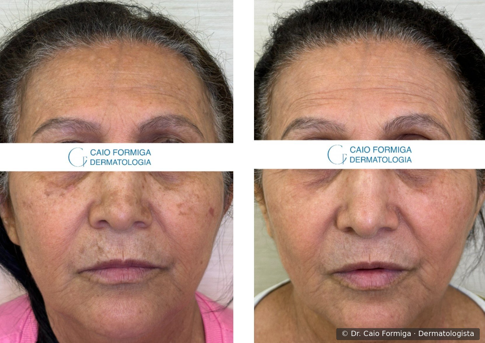 Comparação antes e depois em paciente idosa com melasma e múltiplos lentigos solares em região malar e periorbital, com atenuação importante da pigmentação e melhora da textura cutânea após três sessões de laser CO₂ focal e difuso.