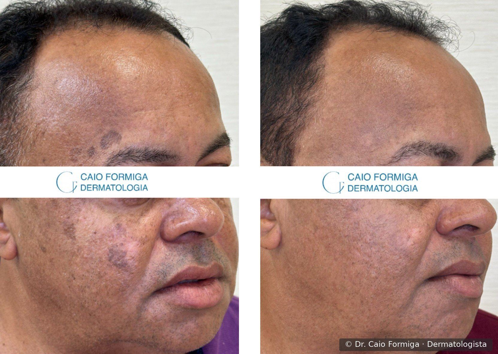 Comparação antes e depois em paciente do sexo masculino com melasma e hipercromia em região malar e perioral lateral, com clareamento marcante após três sessões de laser CO₂ focal e difuso.
