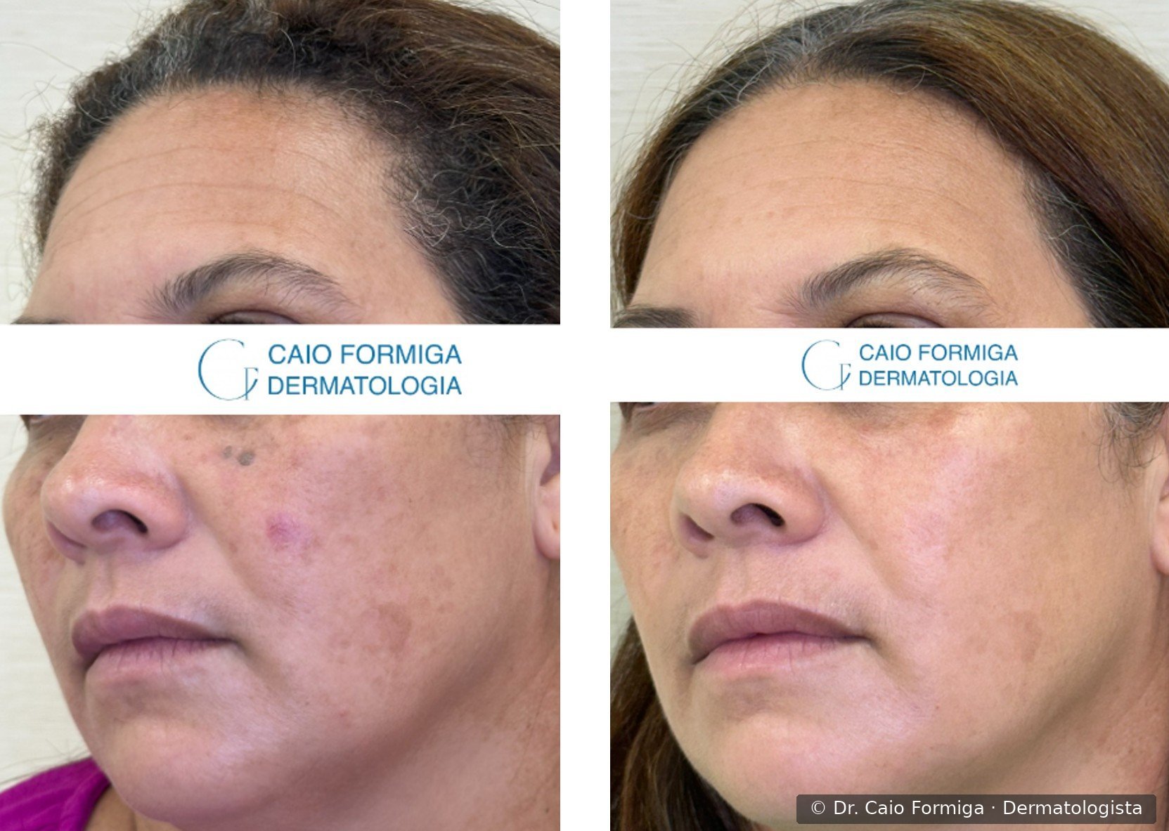 Comparação antes e depois em paciente do sexo feminino com lentigos solares e hiperpigmentação pós-inflamatória em região malar, com pele uniforme e luminosa após três sessões de laser CO₂ focal e difuso.