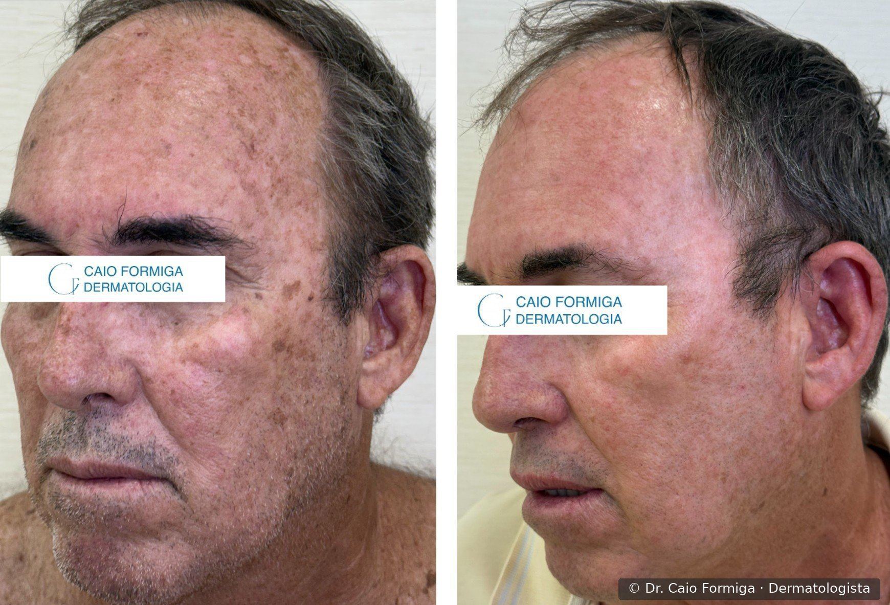 Comparação antes e depois em paciente com campo de cancerização: à esquerda, face com lentigos solares, ceratoses actínicas e eritema difuso; à direita, mesma face após três sessões de laser CO₂ focal e difuso, com pele uniforme e redução marcante do fotodano.