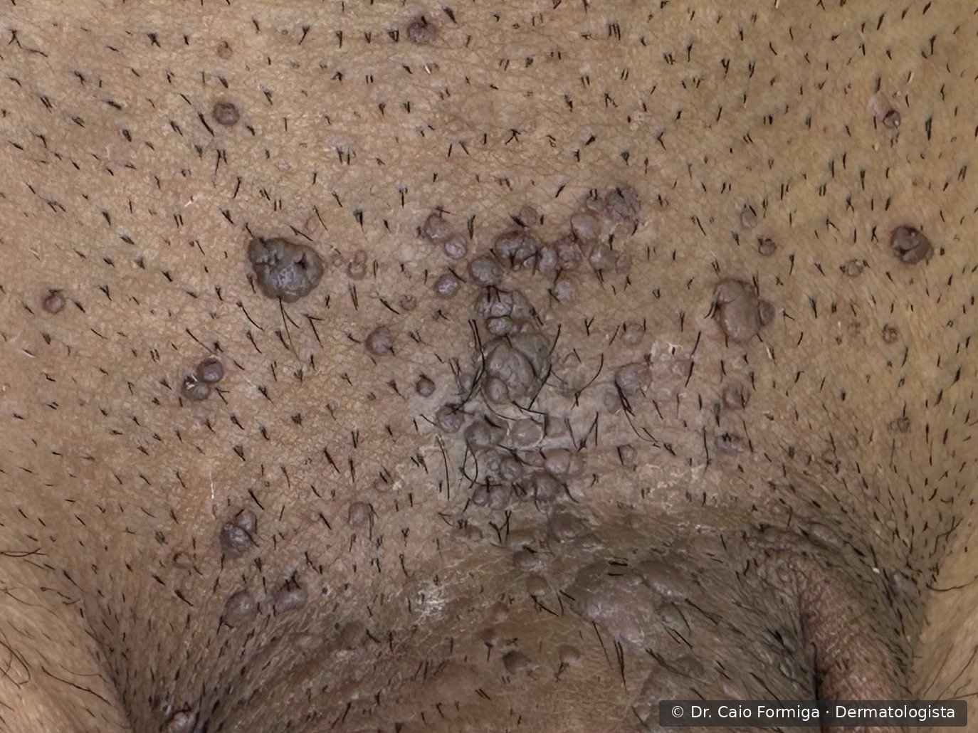 Lesões papulosas verrucosas, da cor da pele a acinzentadas, em região anogenital — condiloma acuminado por HPV.