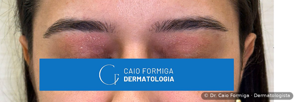 Placa eritematosa com descamação e edema palpebral por contato com esmalte de unhas, padrão eczematoso periocular típico da dermatite de contato alérgica.