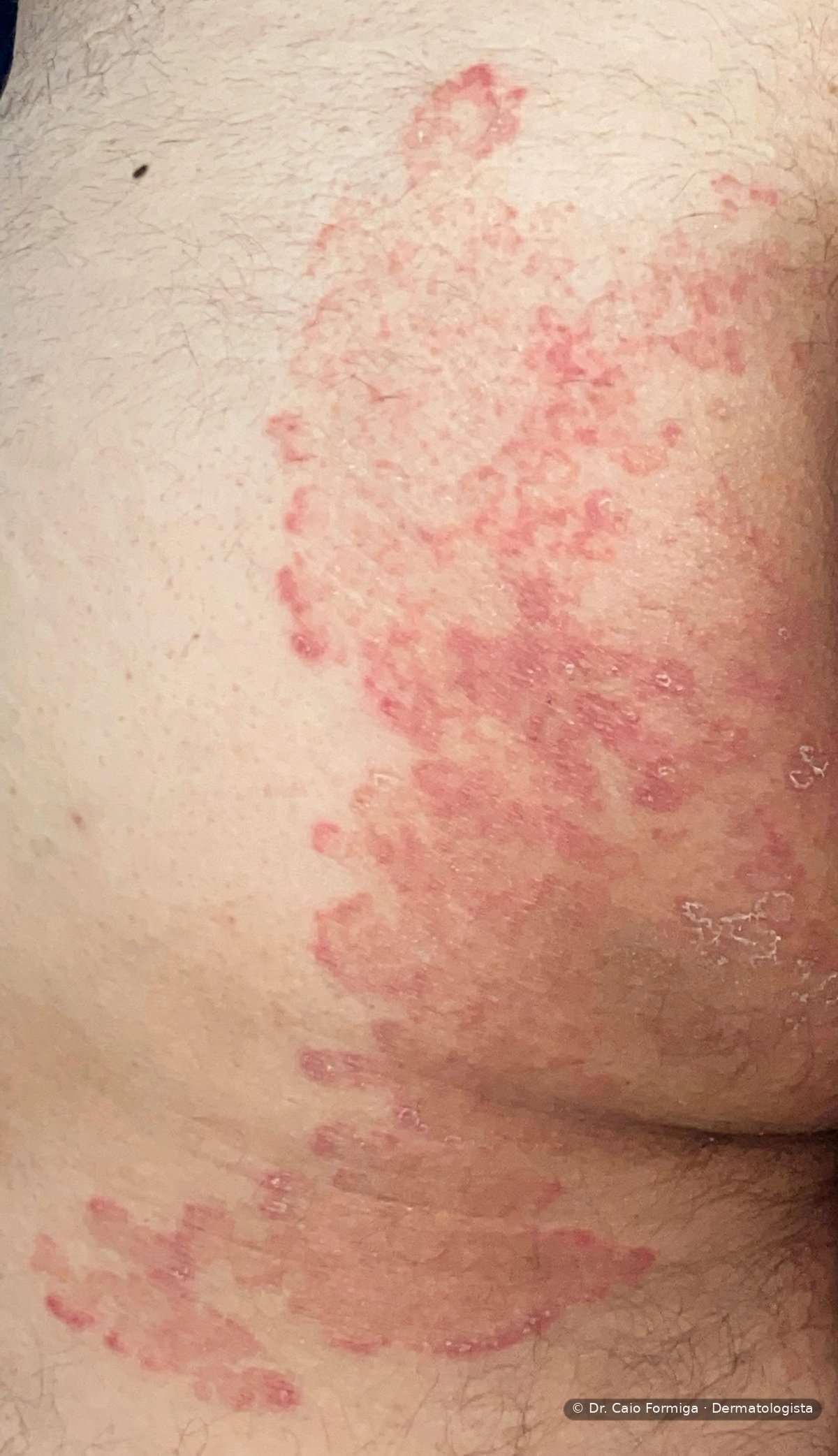 Placa eritematodescamativa com bordas elevadas e clareamento central, configurando o anel típico da dermatofitose.