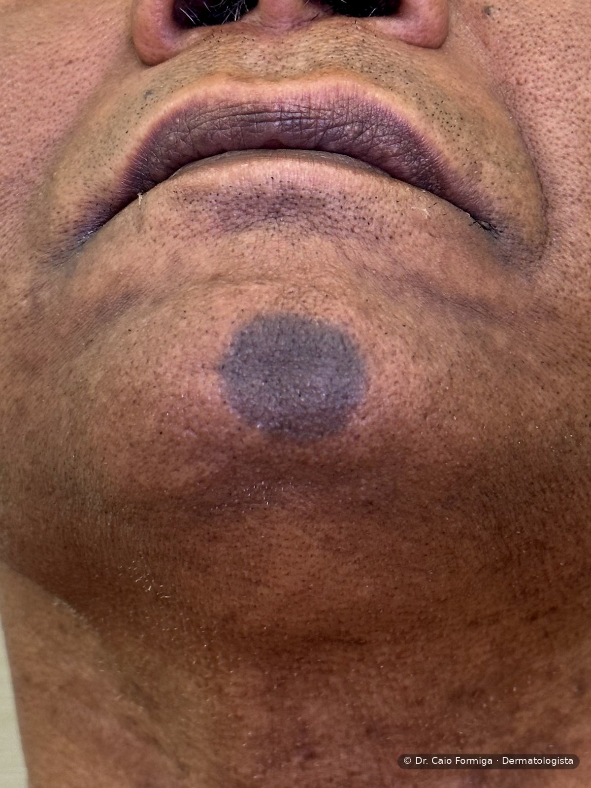 Mácula arredondada hiperpigmentada e violácea bem delimitada na região mentoniana, padrão característico do eritema fixo por droga.