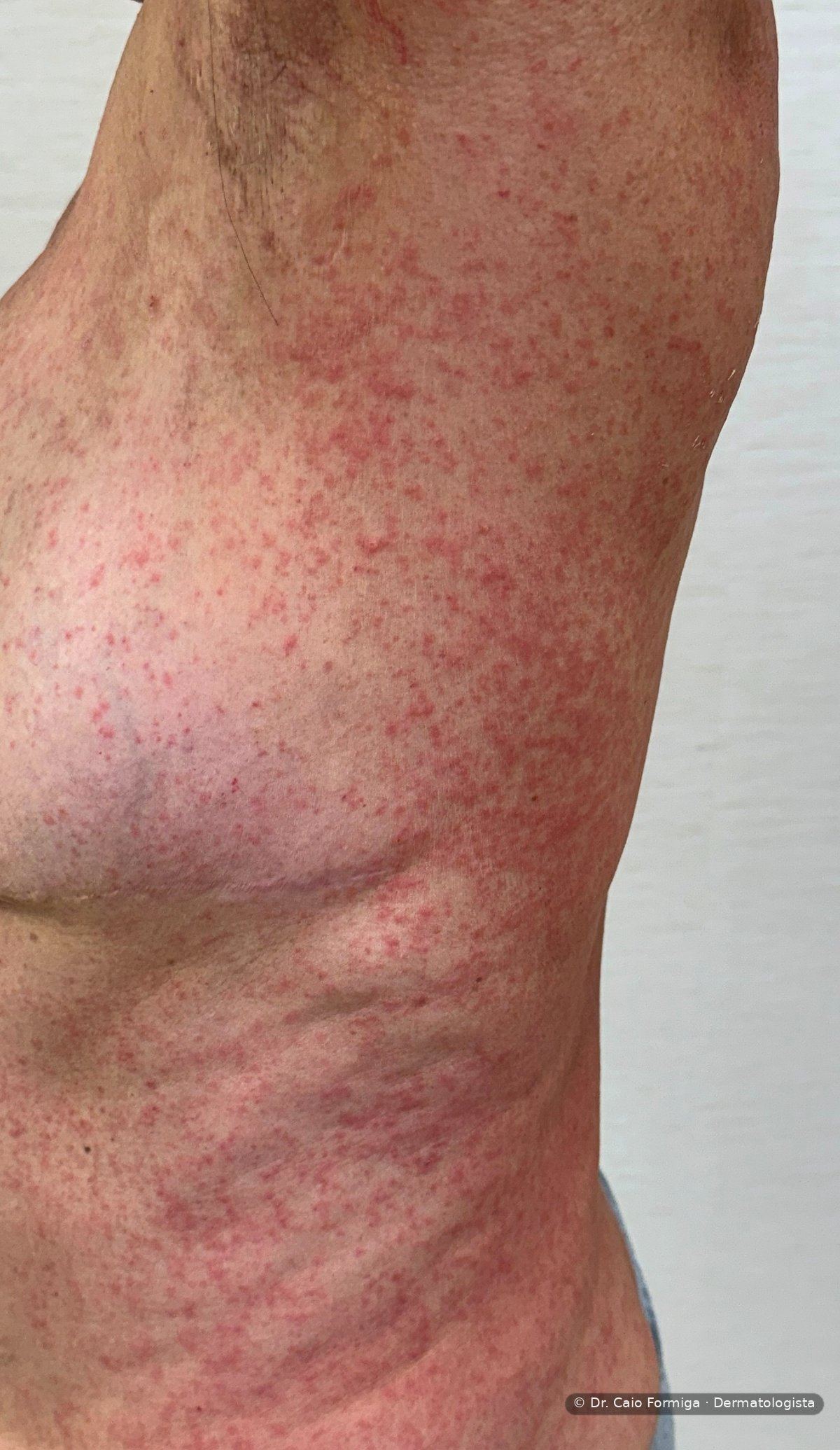 Erupção maculopapular difusa em tronco e membros, padrão clássico de reação cutânea a medicamento.
