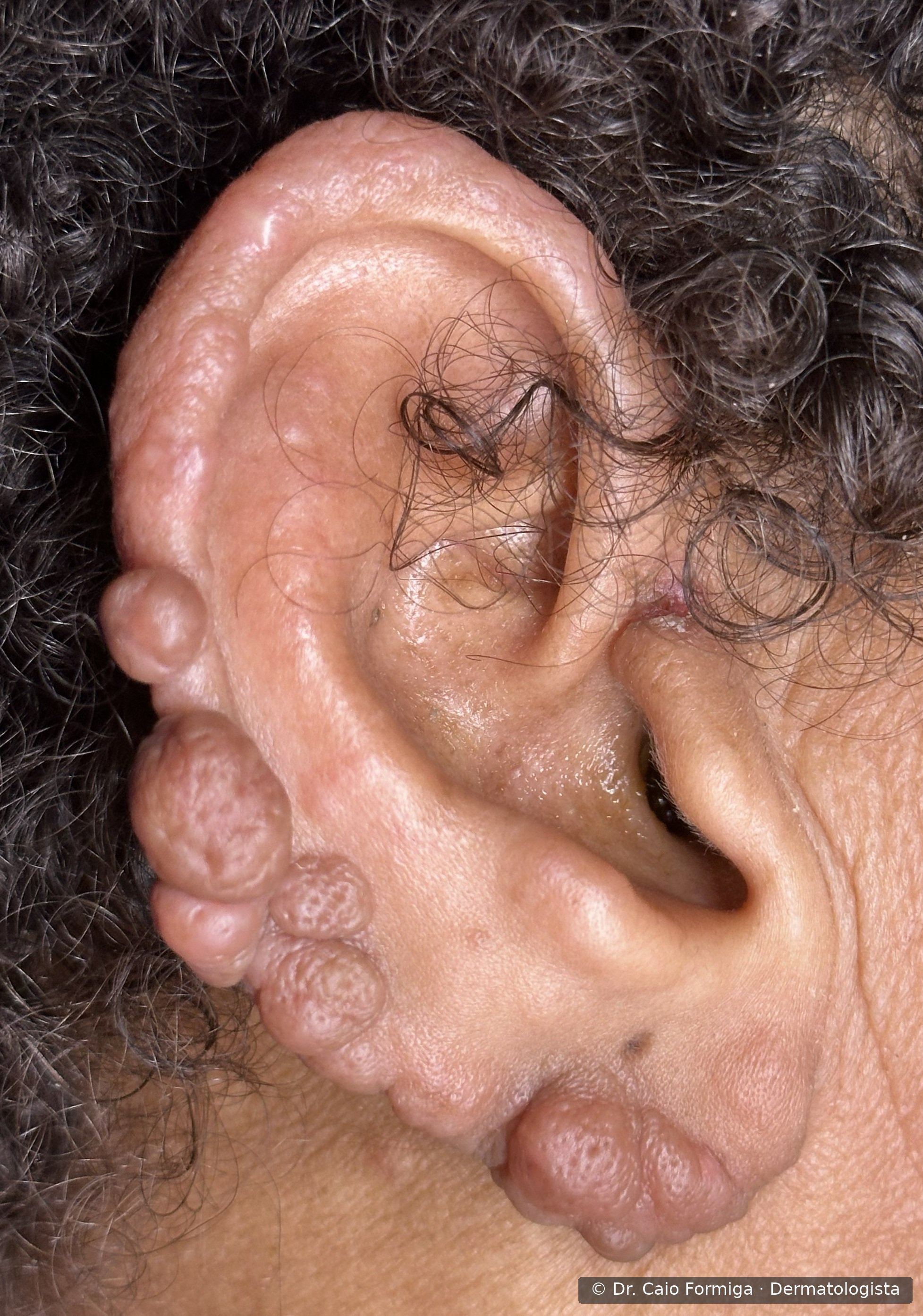 Múltiplos hansenomas infiltrados em hélice, antehélix e lóbulo da orelha, padrão clássico da hanseníase virchowiana, forma multibacilar avançada com alta carga bacilar.