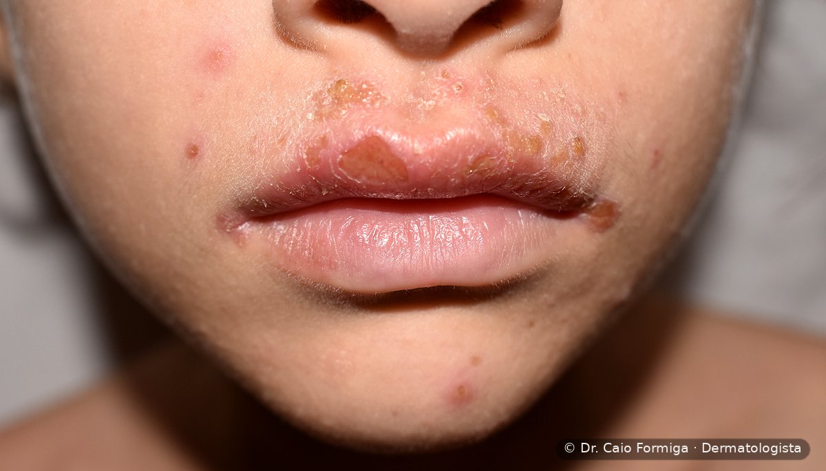 Erosões com crostas amareladas (melicéricas) em face, aspecto clássico do impetigo bacteriano.