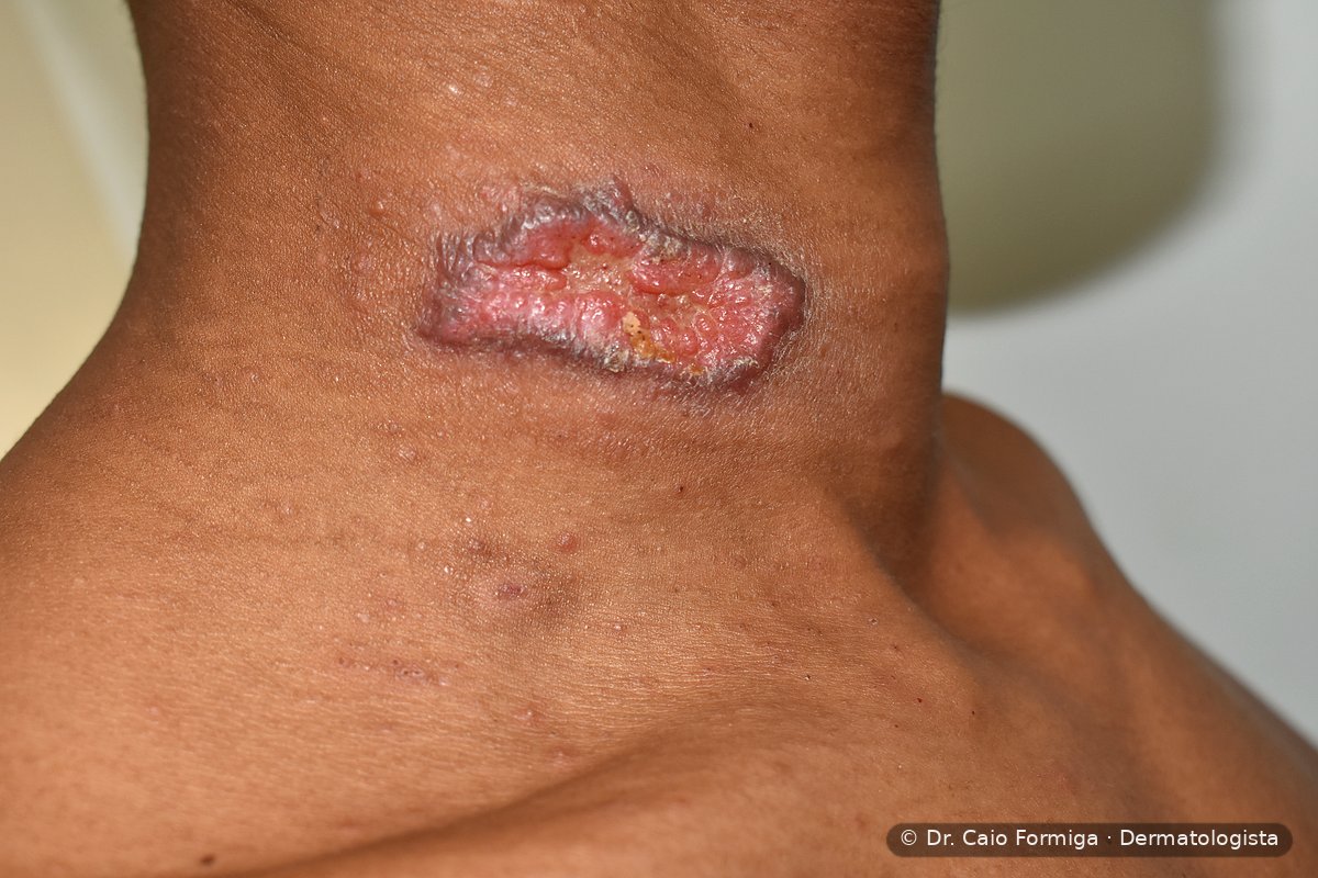 Úlcera linear de bordas elevadas e fundo granuloso com crostas em região cervical, padrão característico da leishmaniose tegumentar.