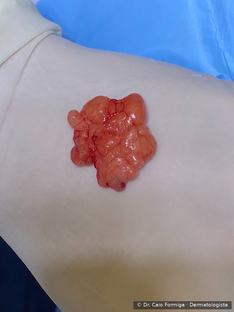 Lipoma exteriorizado durante cirurgia em consultório: tecido adiposo maduro lobulado, brilhante, de coloração rosado-amarelada característica, exposto através de pequena incisão na pele.