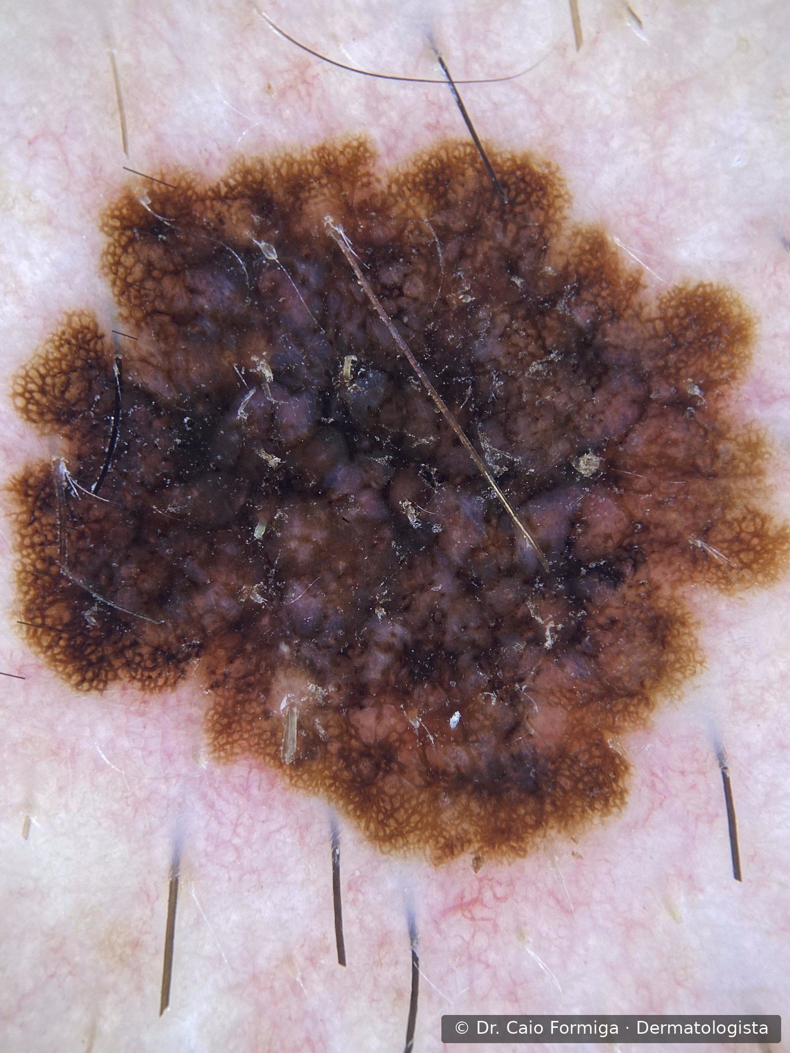 Dermatoscopia evidenciando padrão multicomponente, retículos atípicos e estruturas regredidas, padrão de melanoma.