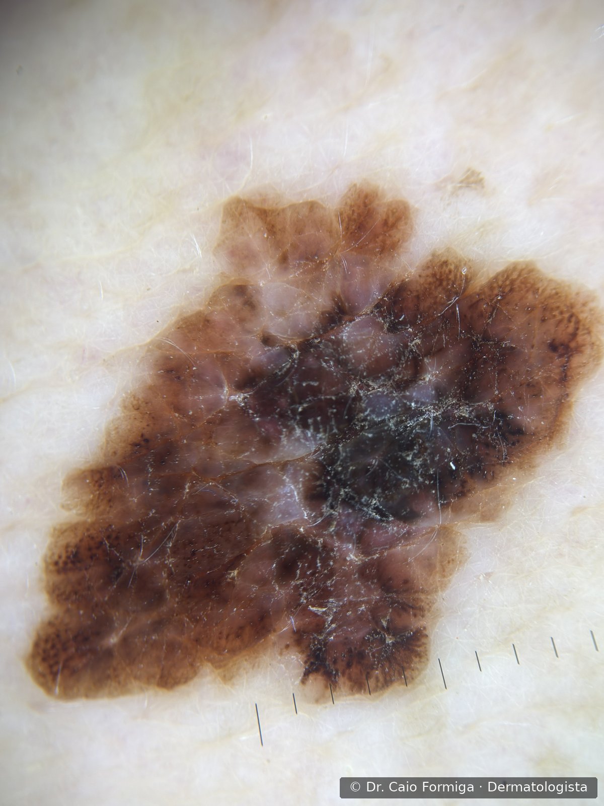 Dermatoscopia com retículo pigmentar atípico e múltiplas estruturas heterogêneas, padrão de melanoma.