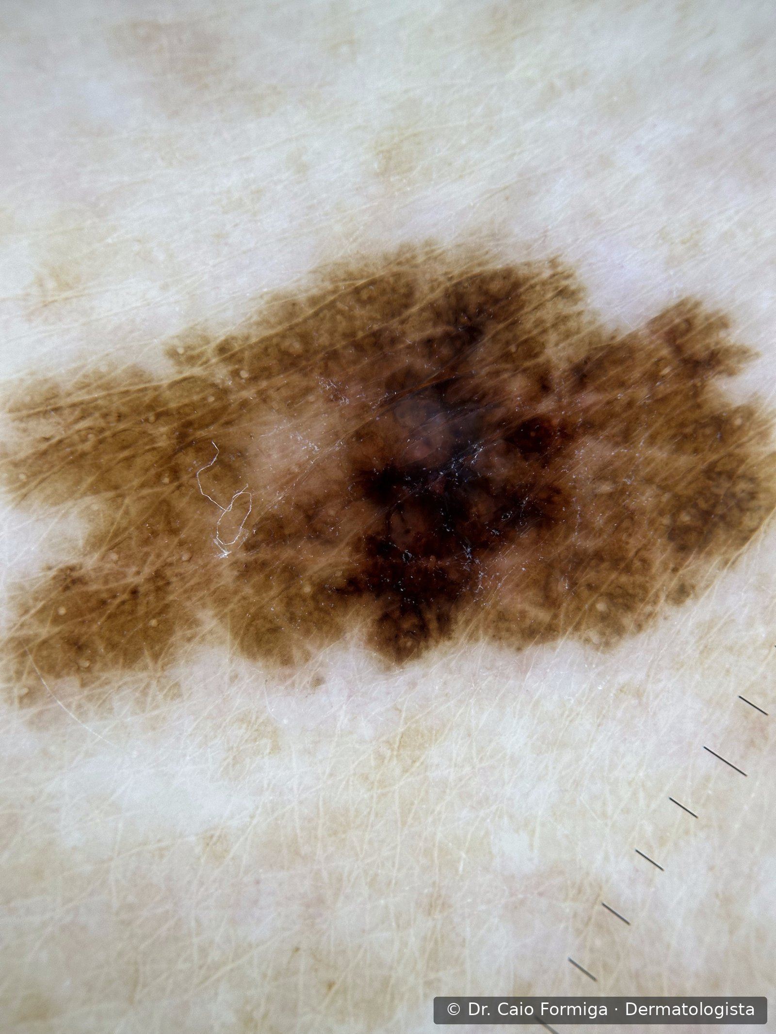 Dermatoscopia com véu azul-esbranquiçado, pseudópodes e linhas radiais — padrão característico de melanoma.