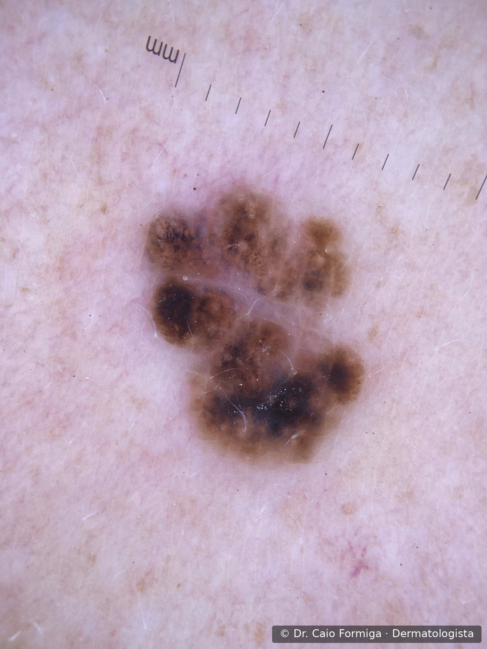 Imagem dermatoscópica com áreas estruturais irregulares, retículo atípico e despigmentação, padrão de melanoma.