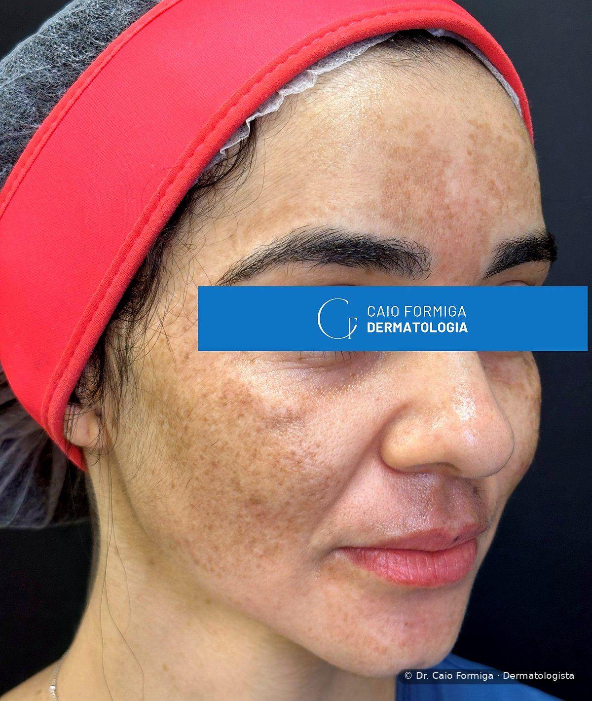 Manchas acastanhadas simétricas em malares e dorso nasal, padrão característico do melasma facial em mulher adulta.