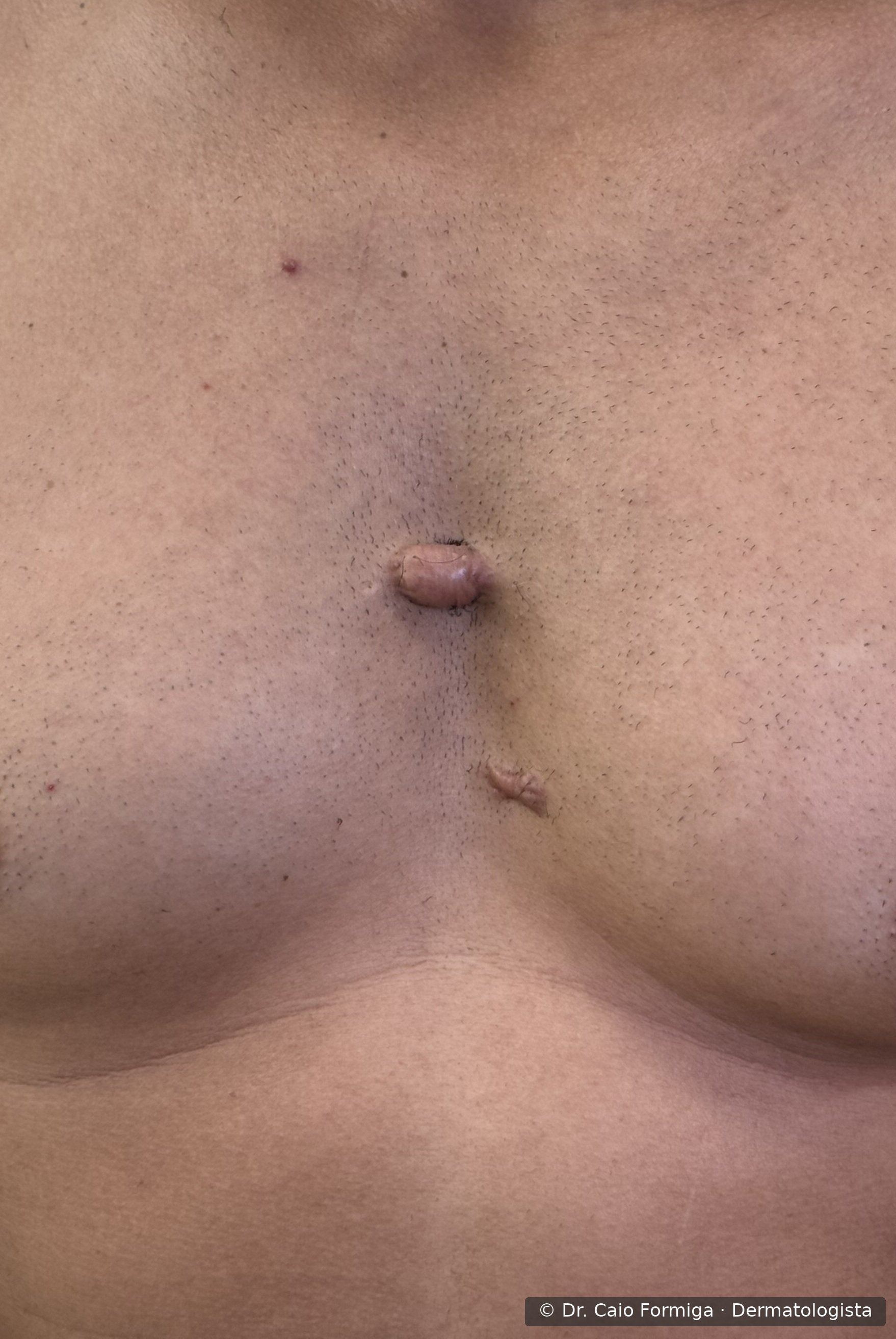 Queloide arredondado e exofítico em região anterior do tórax (colo), com superfície lisa e brilhante, característico da resposta cicatricial exagerada.