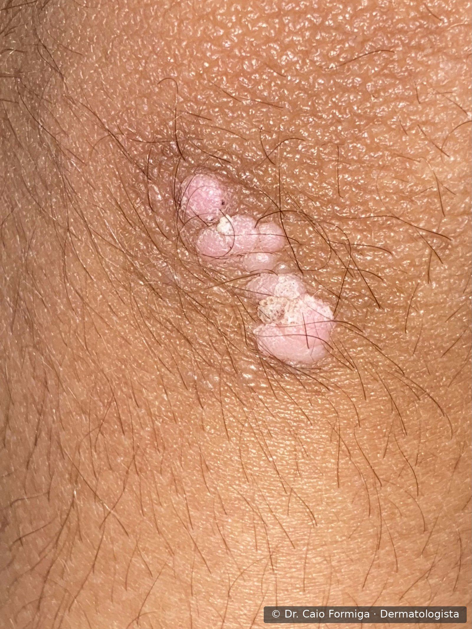 Pápula ceratósica de superfície verrucosa com pontos escurecidos centrais, característica de verruga viral por HPV.