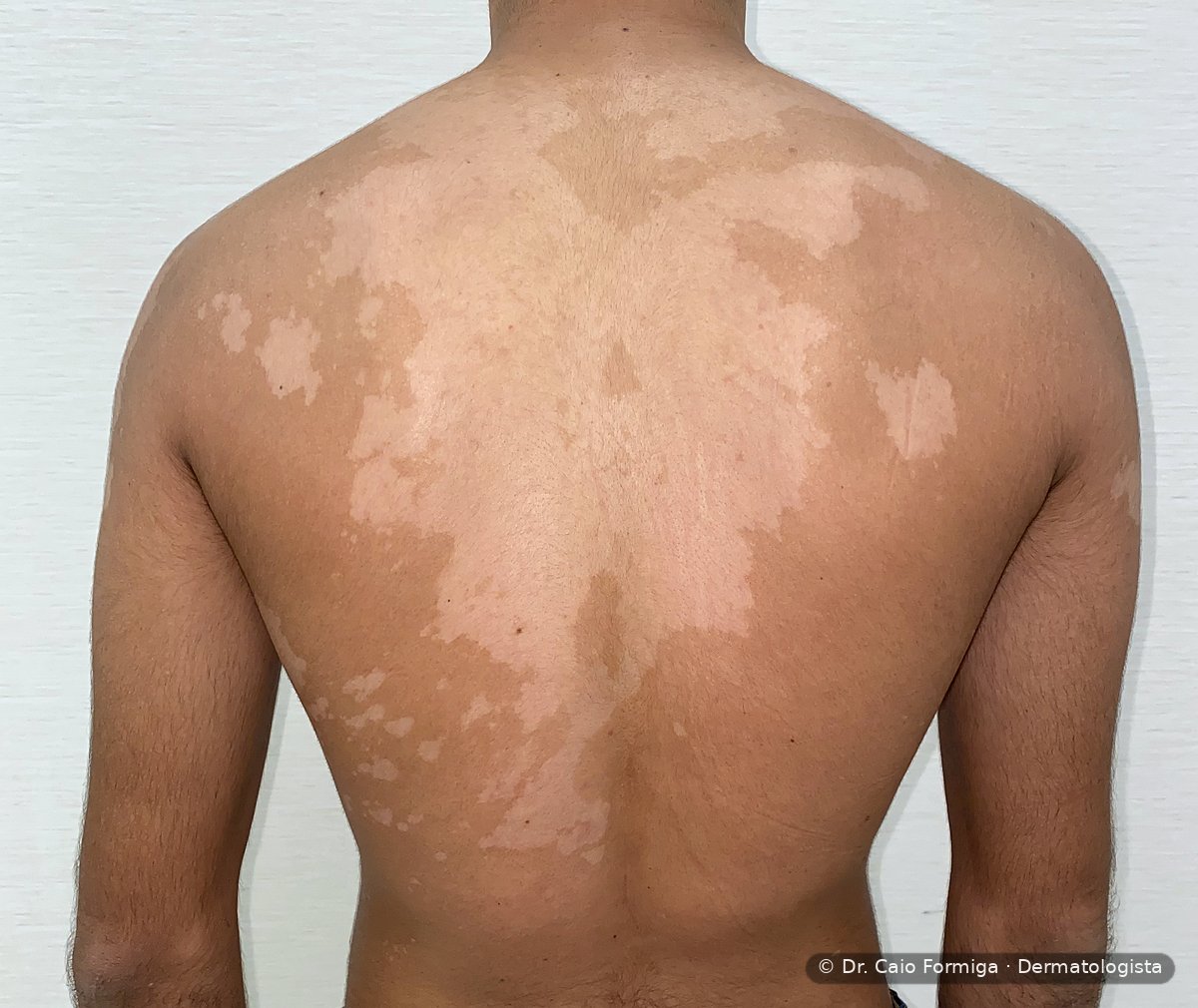 Múltiplas máculas hipocrômicas confluentes em dorso superior, com bordas irregulares e descamação fina, padrão característico da pitiríase versicolor.