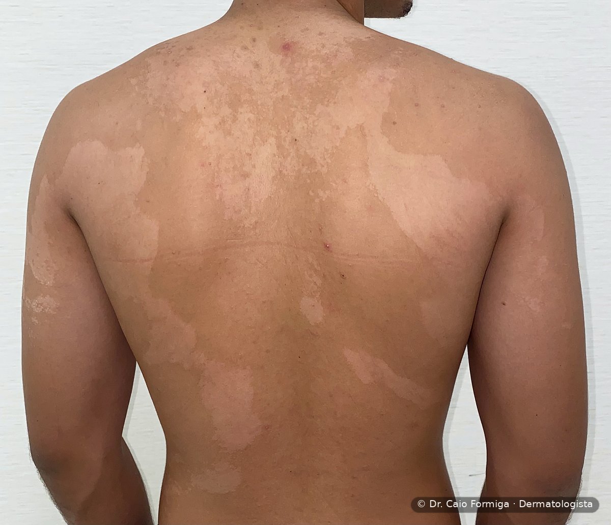 Manchas hipocrômicas distribuídas em dorso e ombros com bordas mal definidas, característico da pitiríase versicolor.