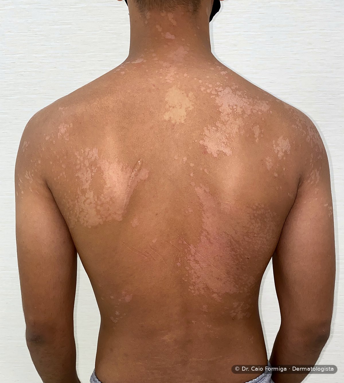 Pitiríase versicolor em dorso com máculas hipocrômicas e hipercrômicas confluentes em ombros e região cervical.